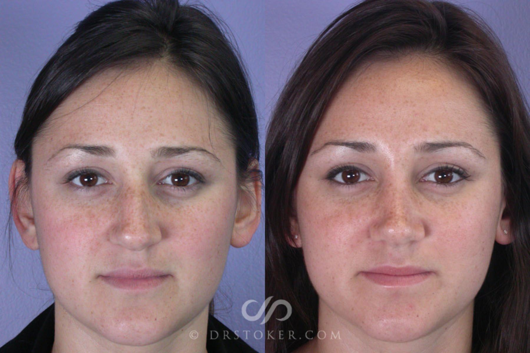 Before & After Rhinoplasty Case 294 View #1 View in Los Angeles, CA