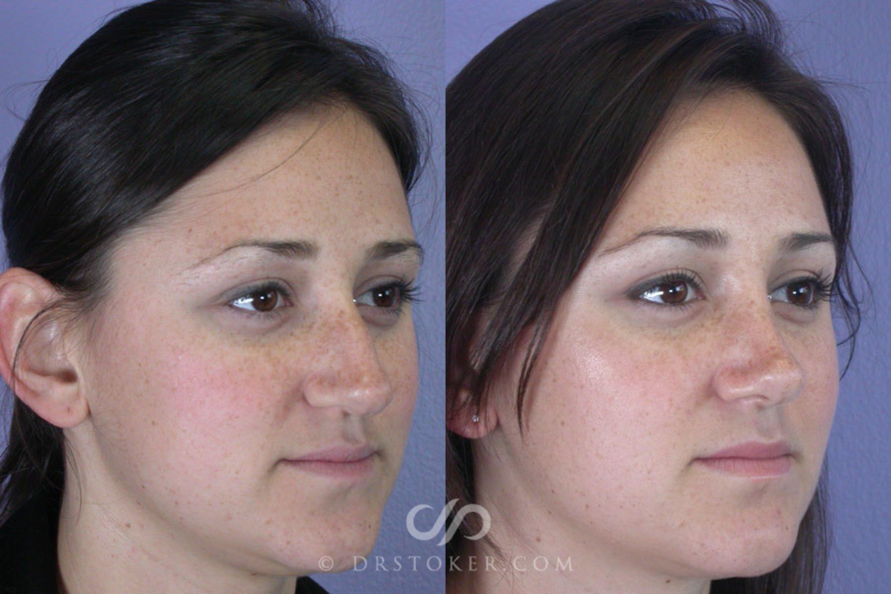 Before & After Rhinoplasty Case 294 View #2 View in Los Angeles, CA