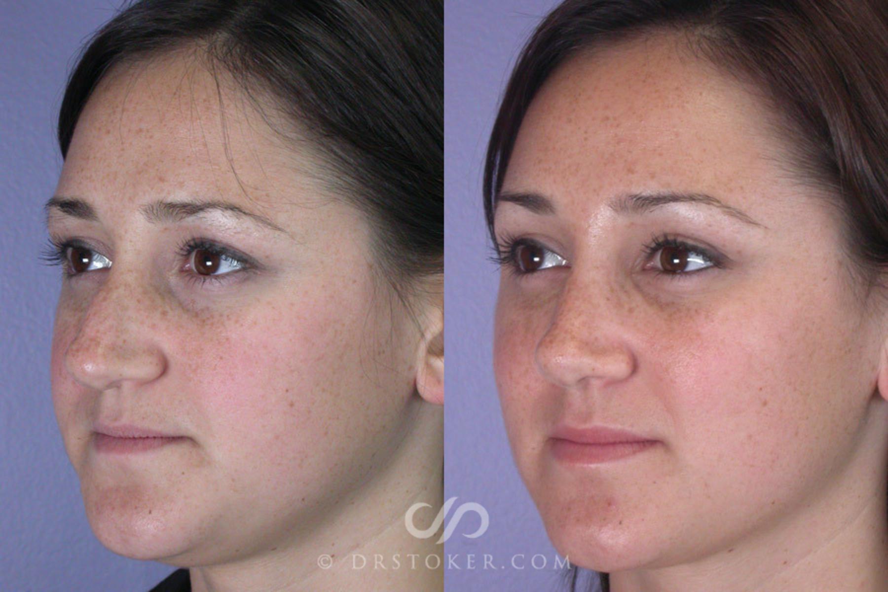 Before & After Rhinoplasty Case 294 View #3 View in Los Angeles, CA