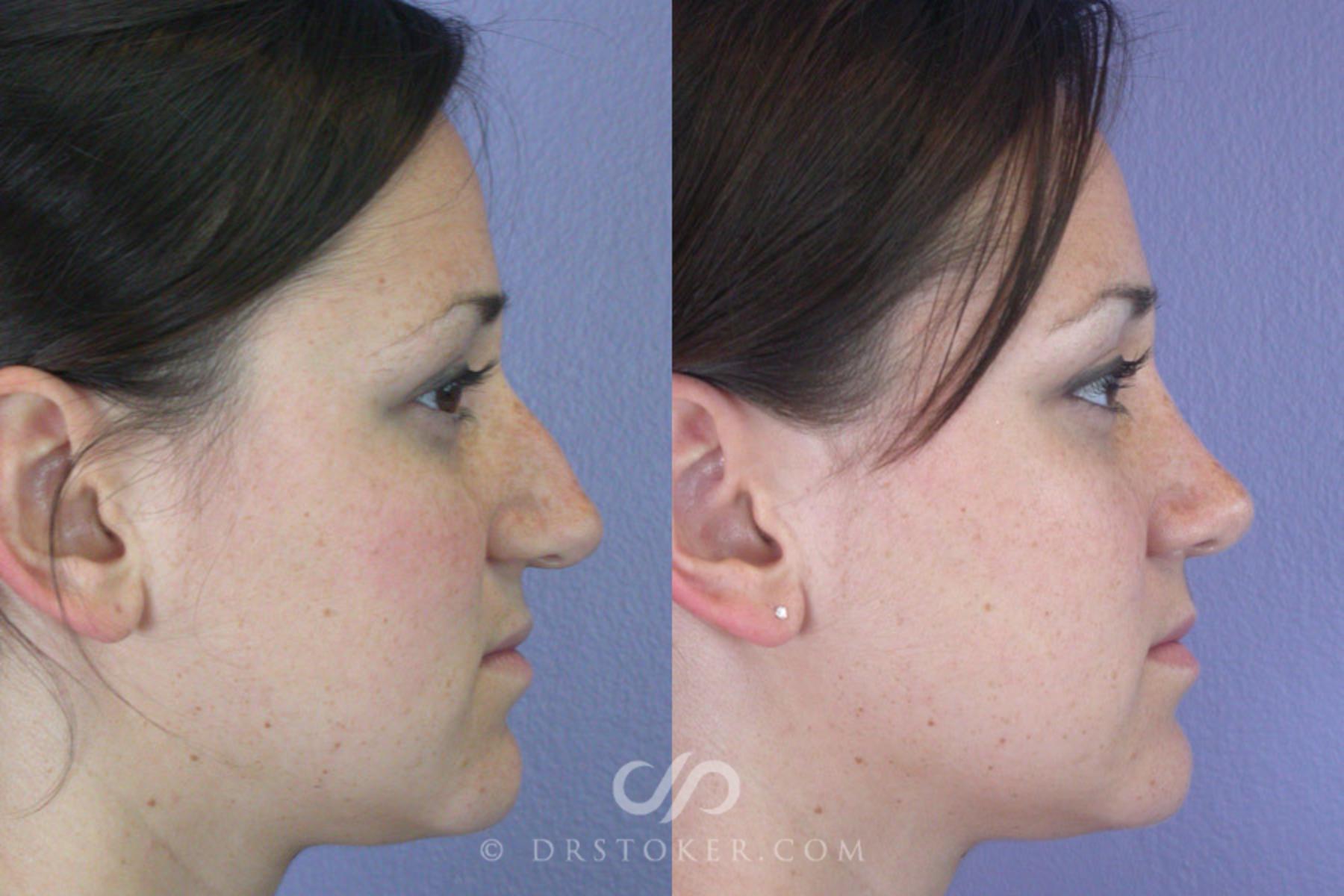 Before & After Rhinoplasty Case 294 View #4 View in Los Angeles, CA