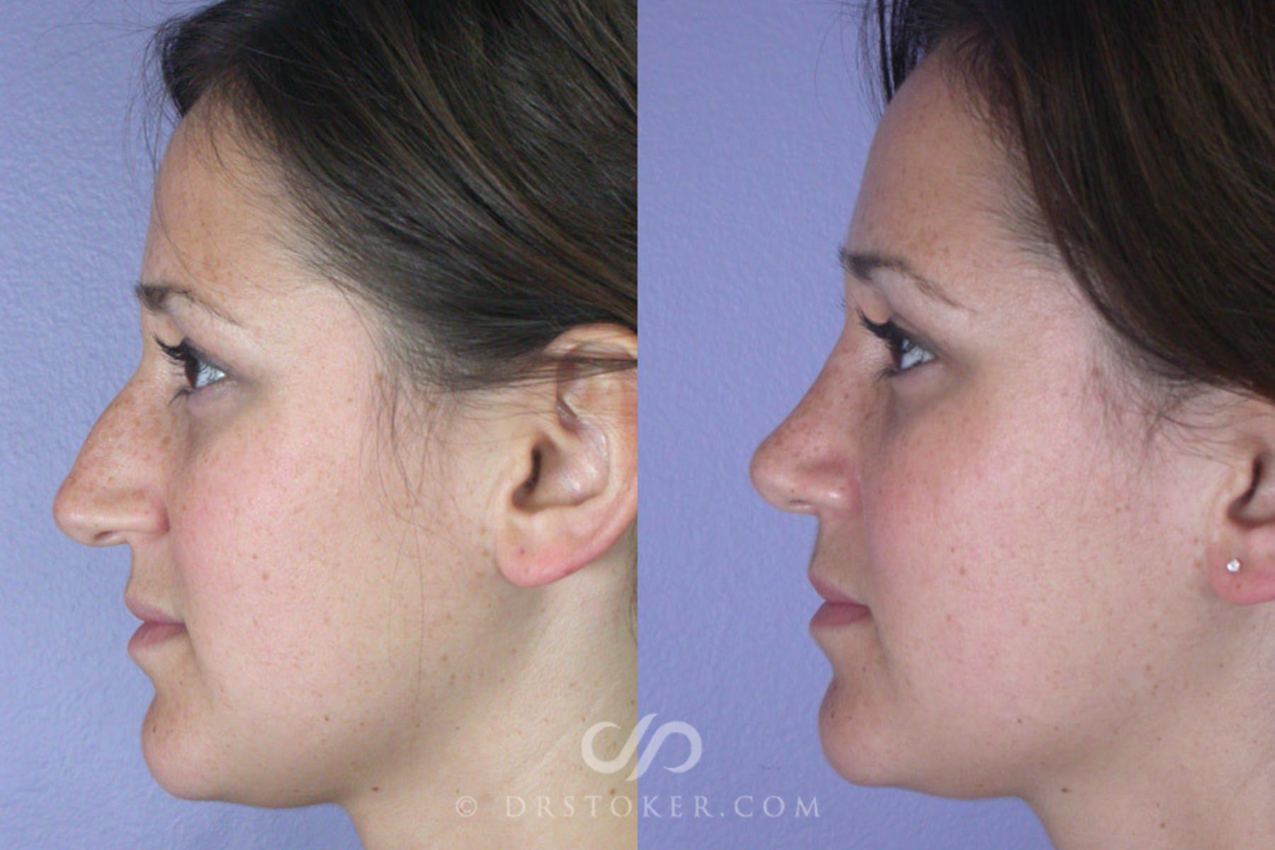 Before & After Rhinoplasty Case 294 View #5 View in Los Angeles, CA