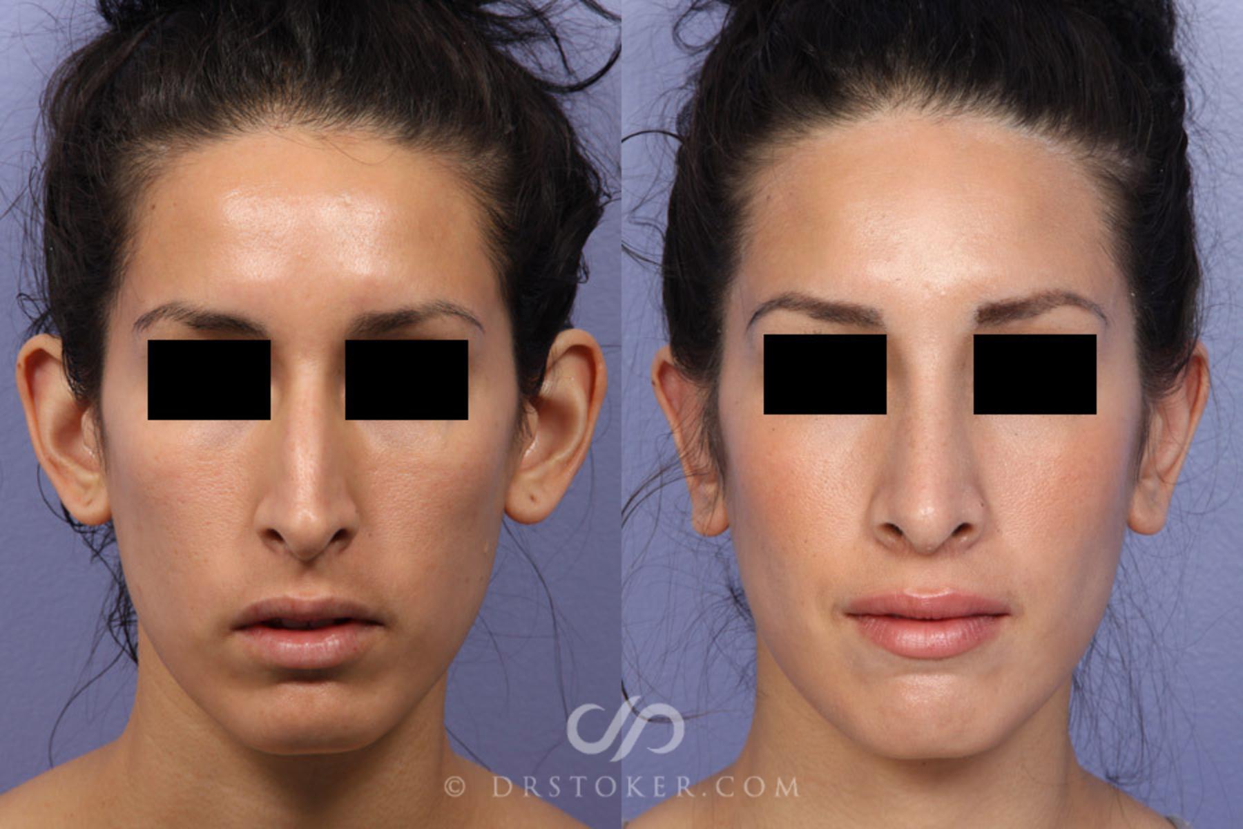 Before & After Rhinoplasty Case 302 View #1 View in Los Angeles, CA