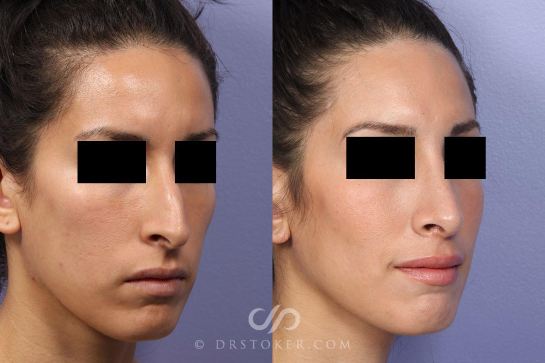 Before & After Rhinoplasty Case 302 View #2 View in Los Angeles, CA