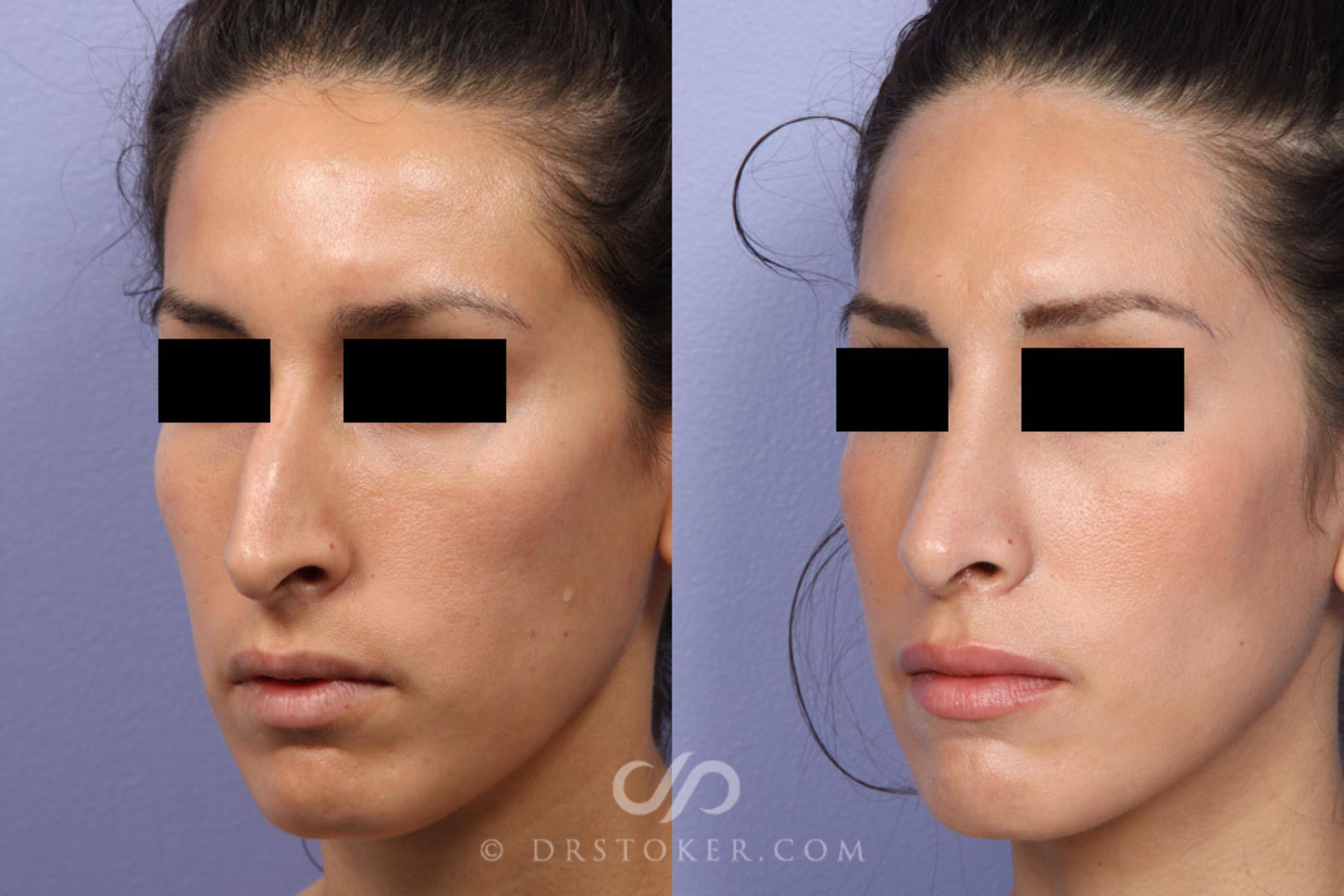 Before & After Rhinoplasty Case 302 View #3 View in Los Angeles, CA