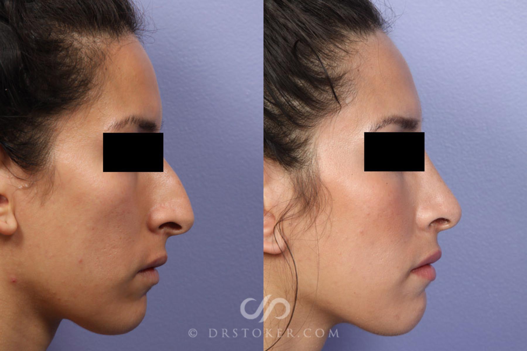 Before & After Rhinoplasty Case 302 View #4 View in Los Angeles, CA