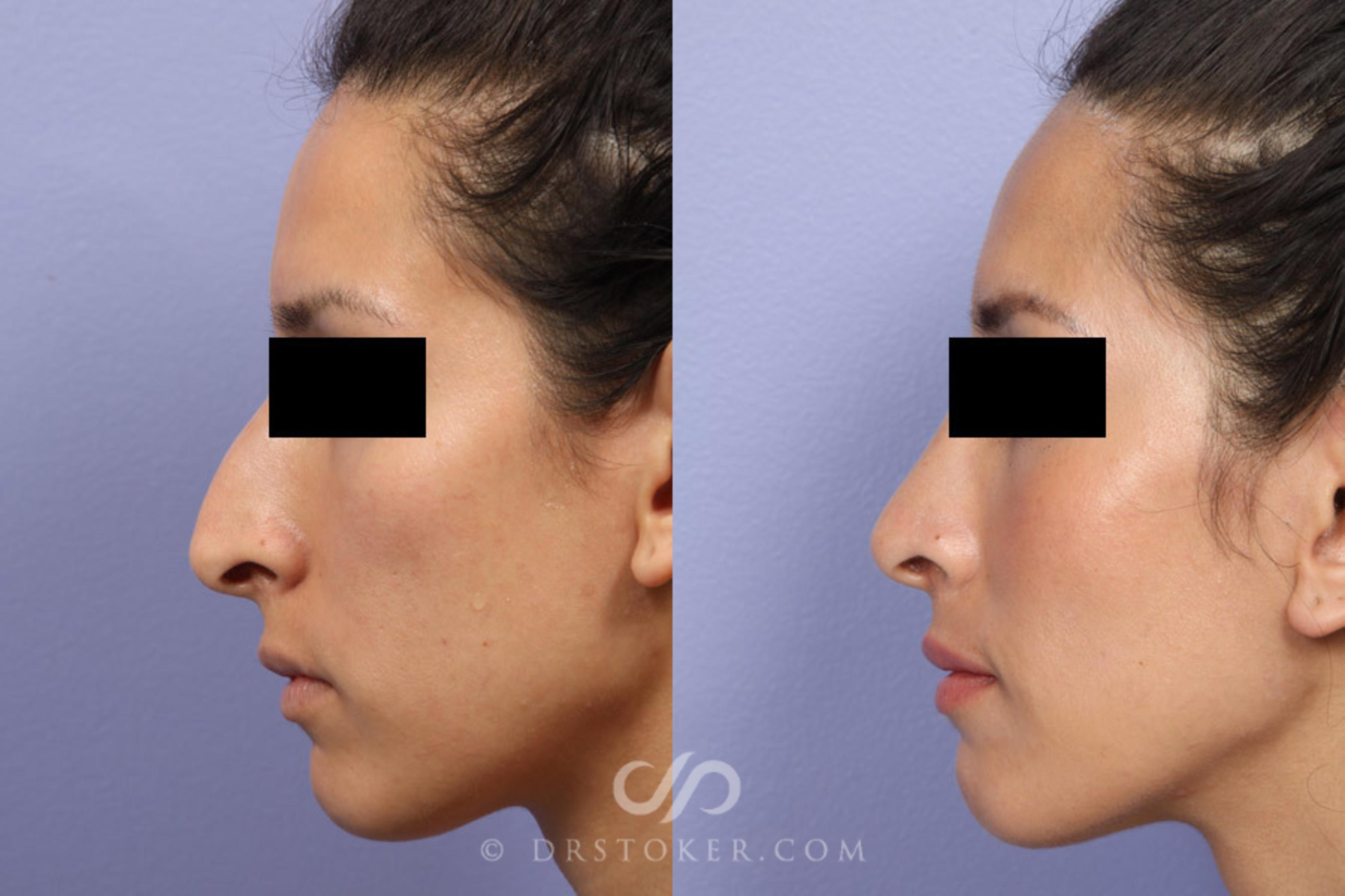 Before & After Rhinoplasty Case 302 View #5 View in Los Angeles, CA