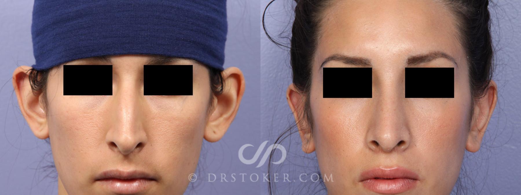 Before & After Rhinoplasty Case 302 View #6 View in Los Angeles, CA