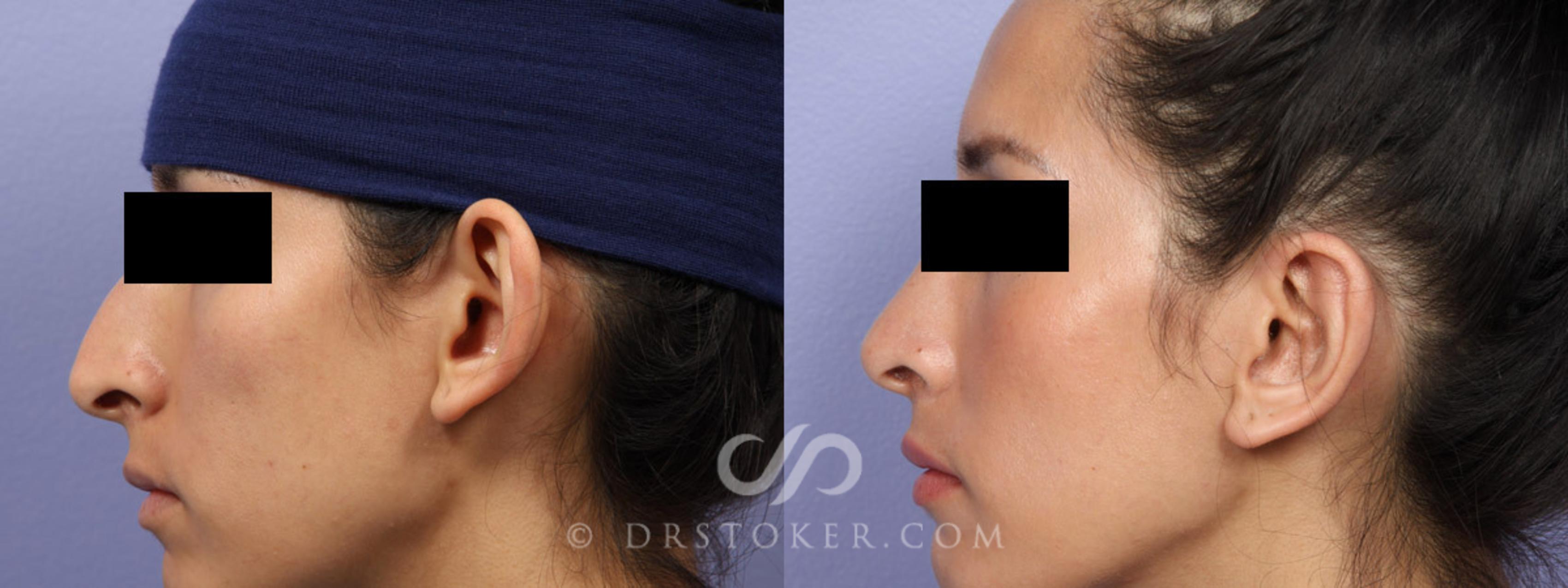 Before & After Rhinoplasty Case 302 View #7 View in Los Angeles, CA