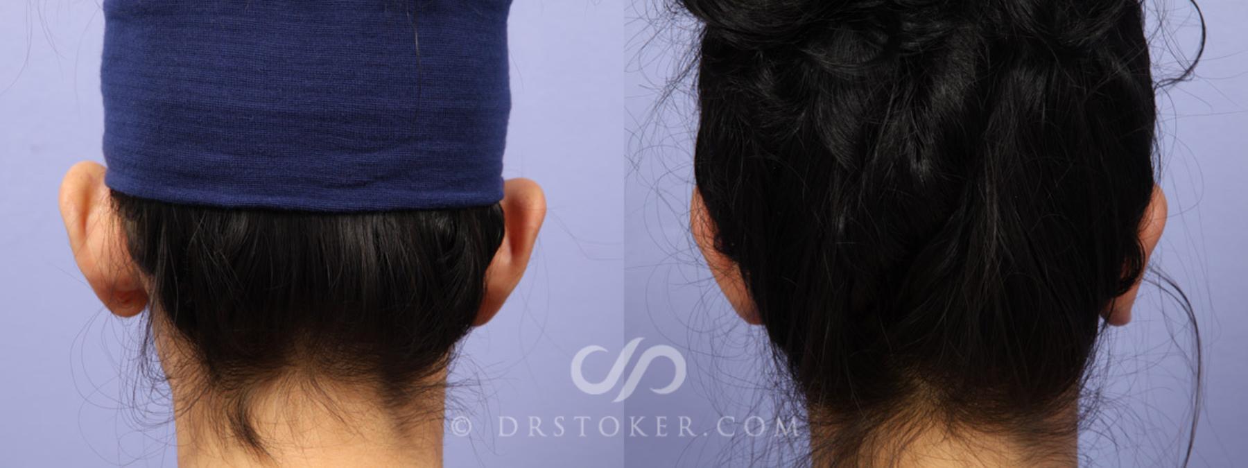 Before & After Rhinoplasty Case 302 View #8 View in Los Angeles, CA
