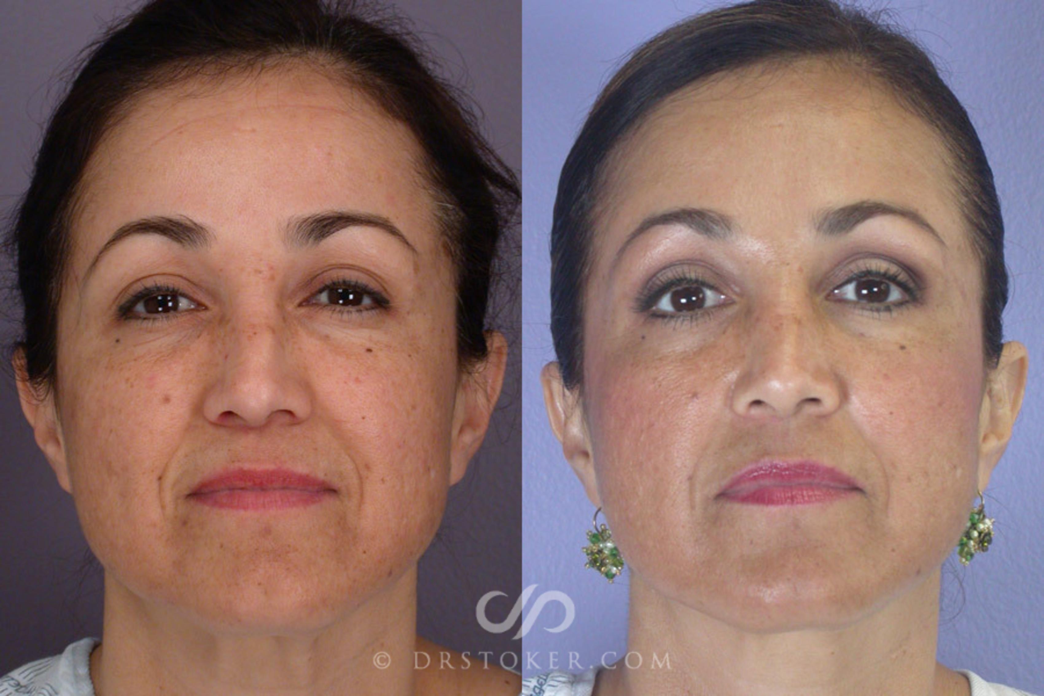 Before & After Rhinoplasty Case 303 View #1 View in Los Angeles, CA