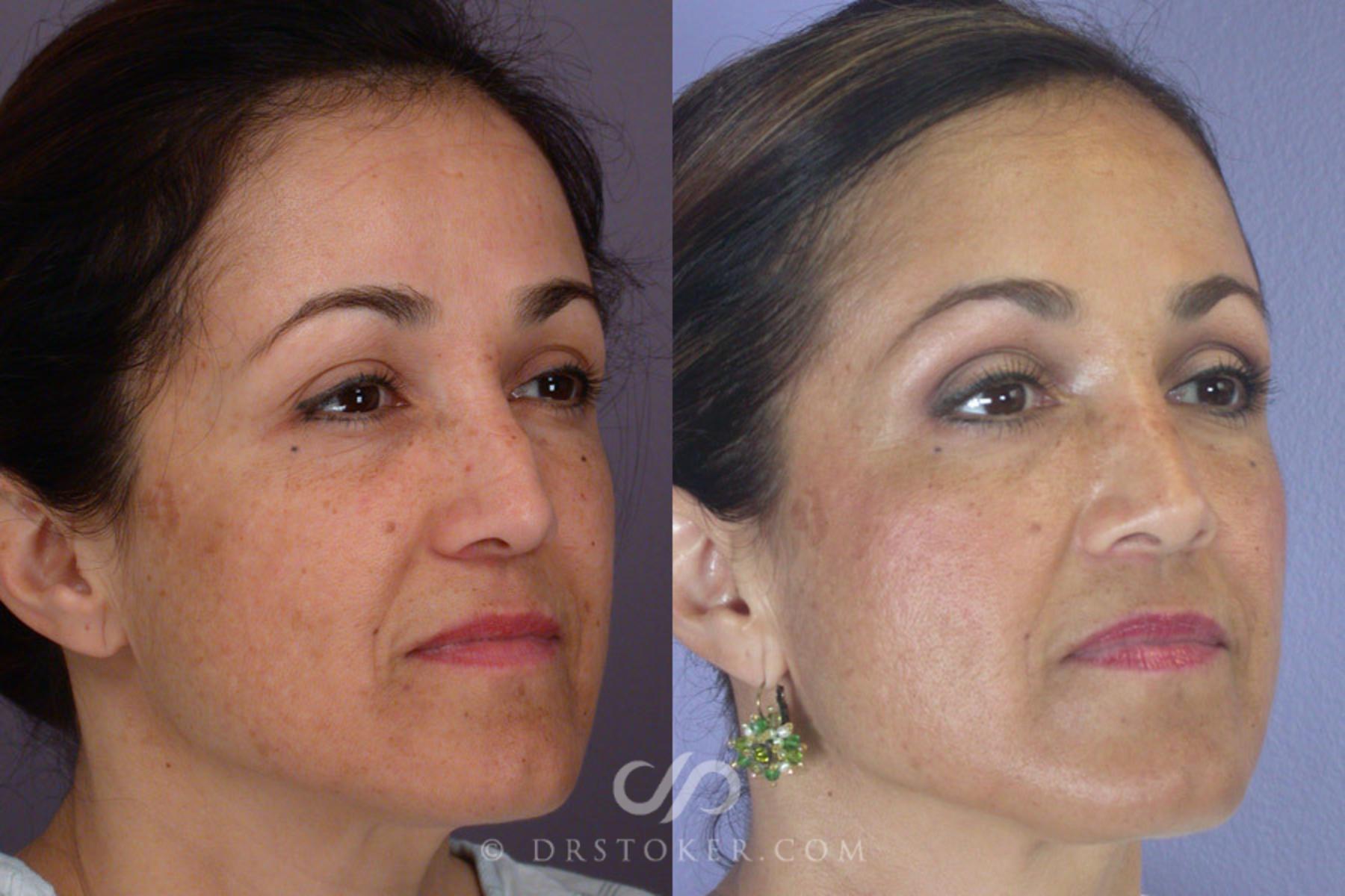 Before & After Rhinoplasty Case 303 View #2 View in Los Angeles, CA