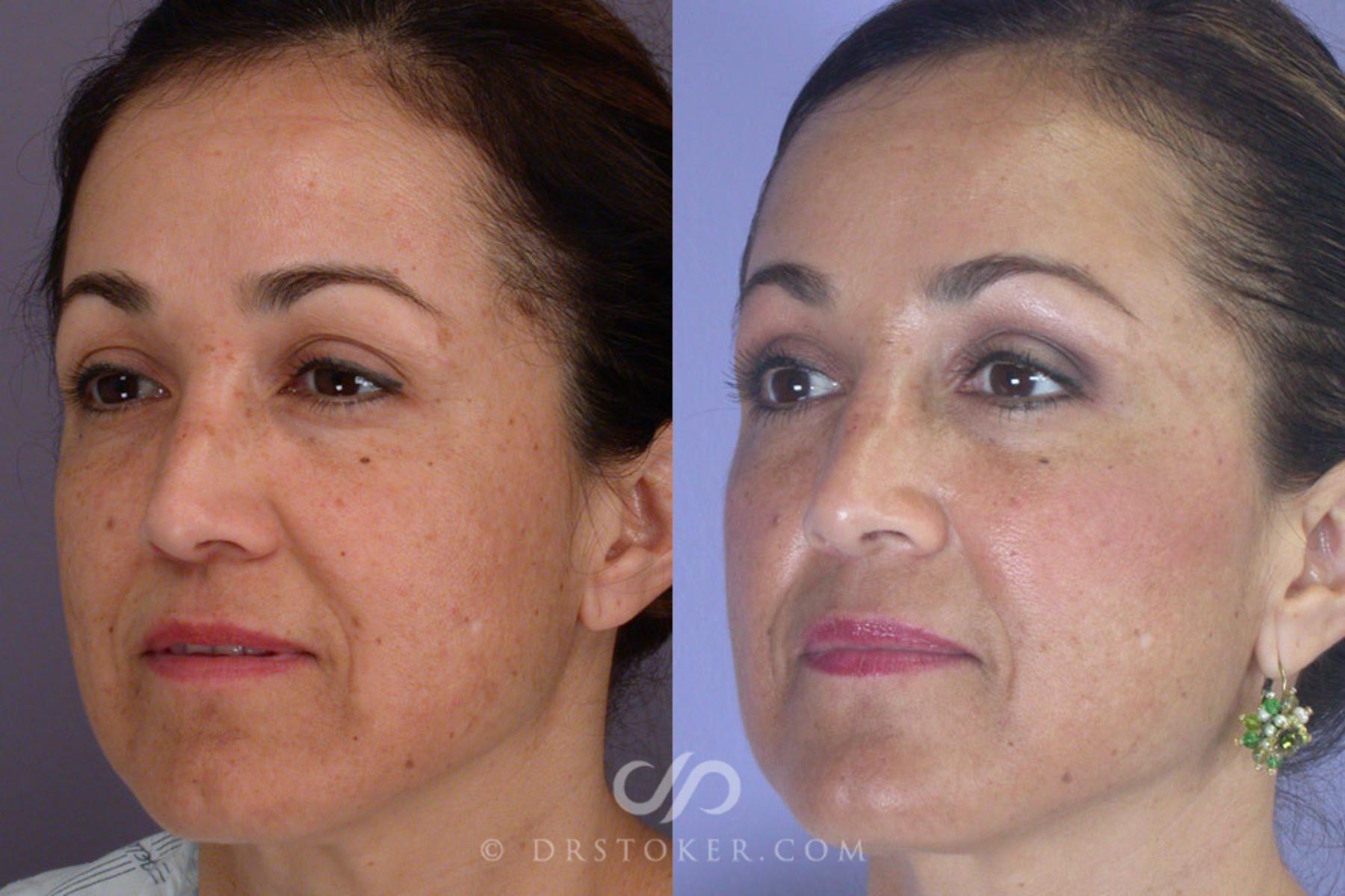 Before & After Rhinoplasty Case 303 View #3 View in Los Angeles, CA