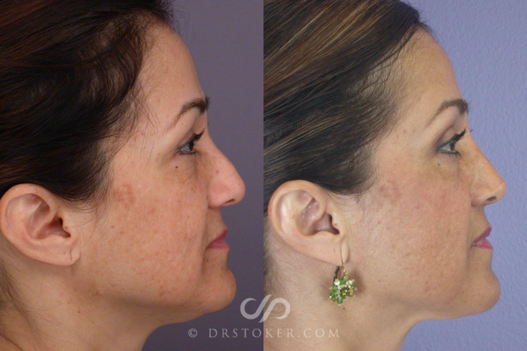 Before & After Rhinoplasty Case 303 View #4 View in Los Angeles, CA