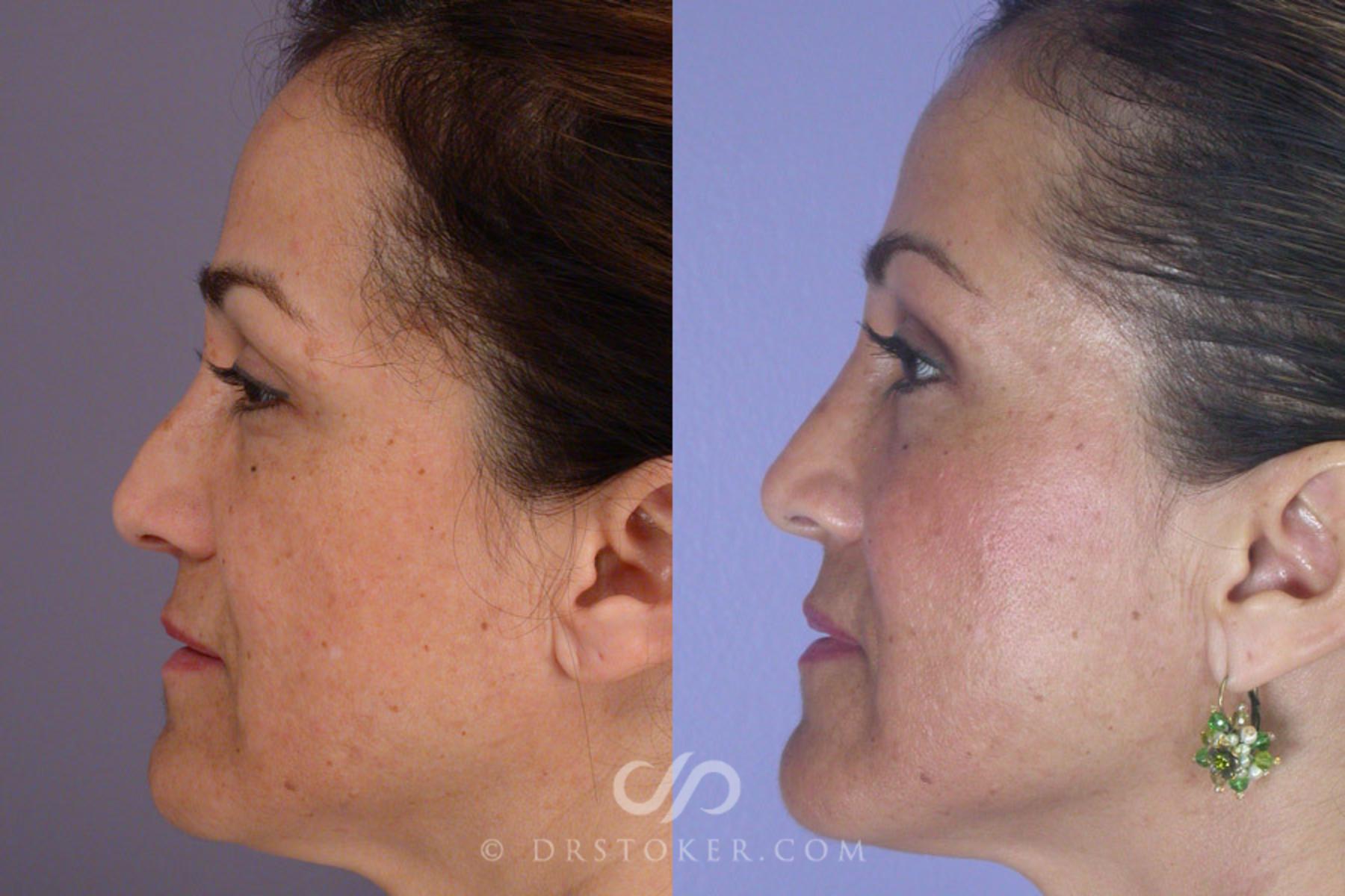 Before & After Rhinoplasty Case 303 View #5 View in Los Angeles, CA