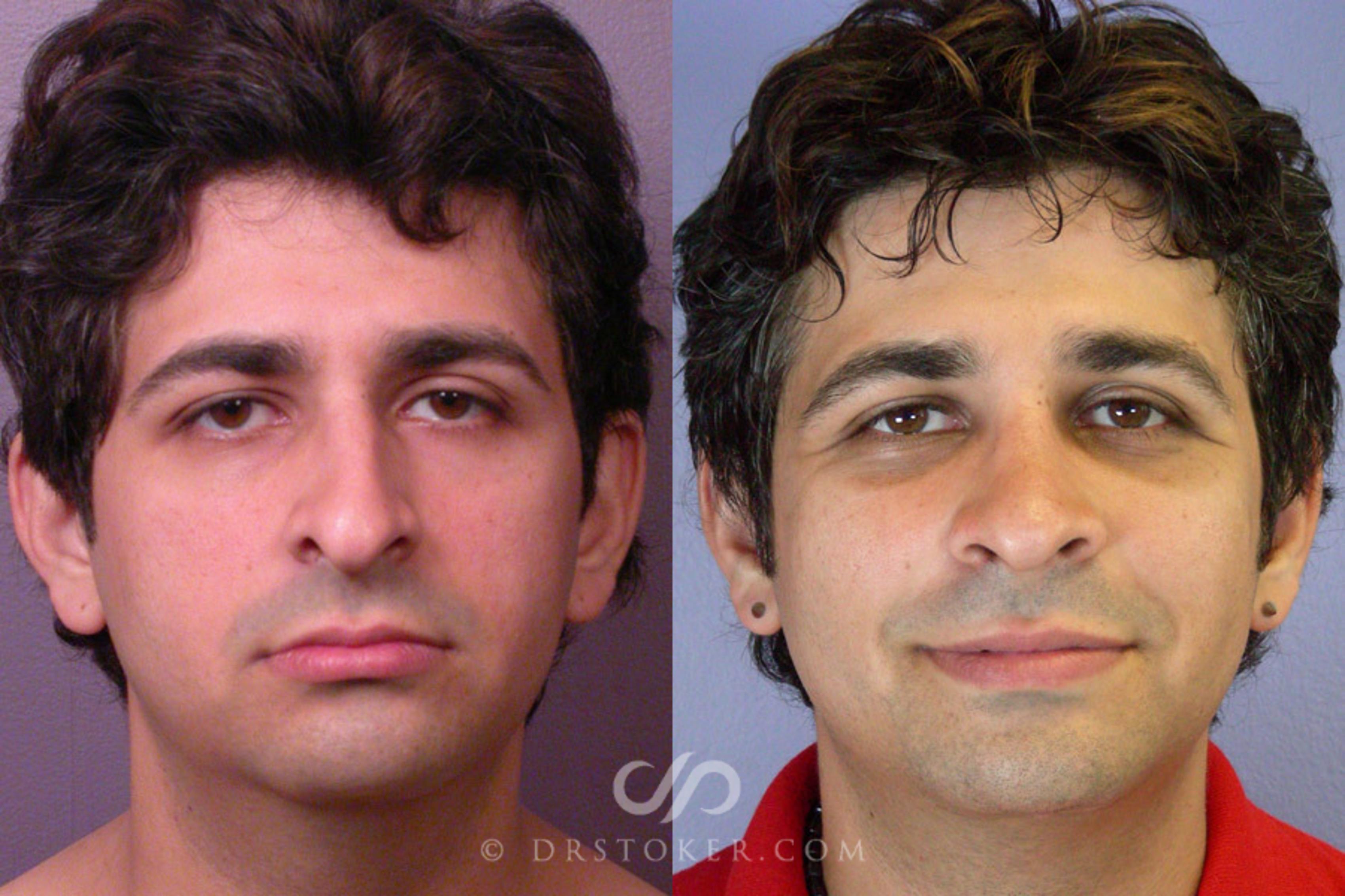 Before & After Rhinoplasty Case 304 View #1 View in Los Angeles, CA