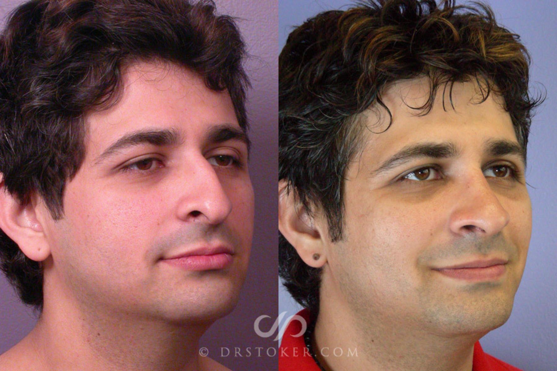 Before & After Rhinoplasty Case 304 View #2 View in Los Angeles, CA