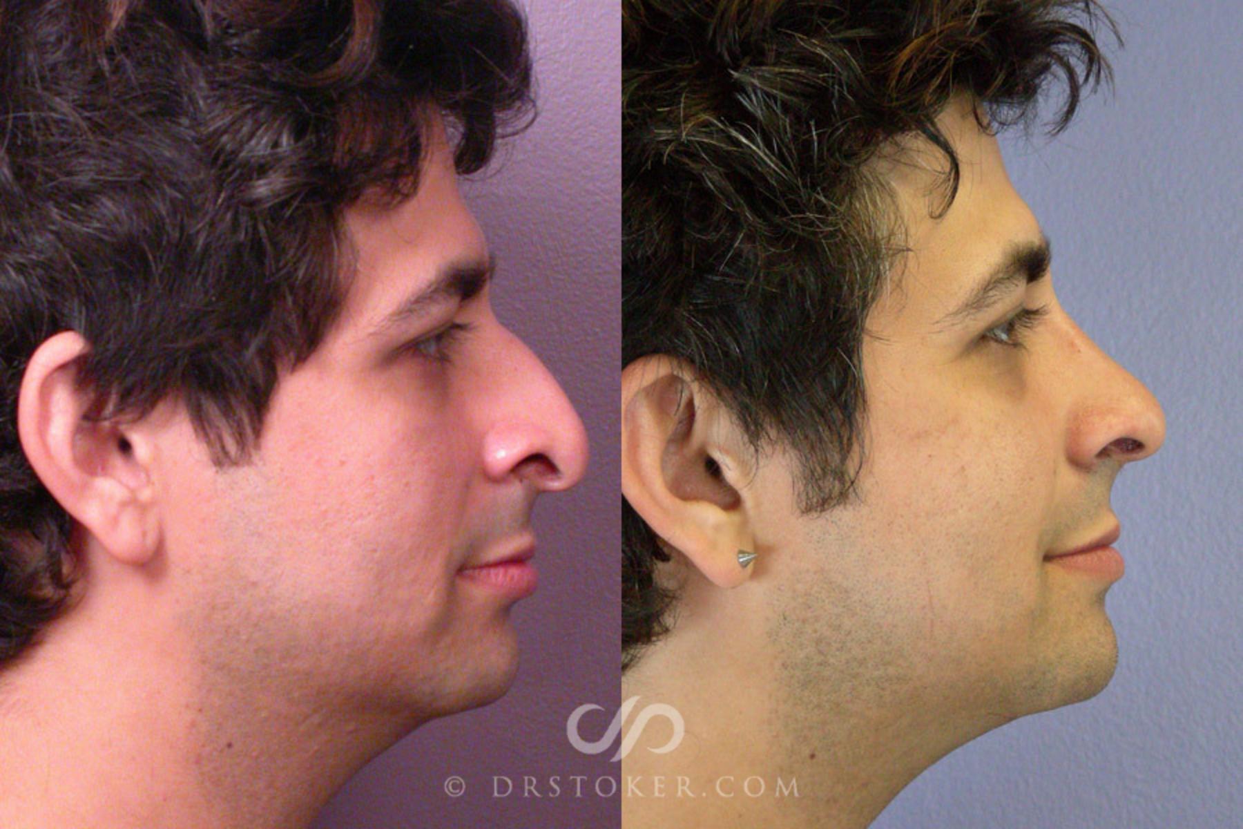 Before & After Rhinoplasty Case 304 View #4 View in Los Angeles, CA