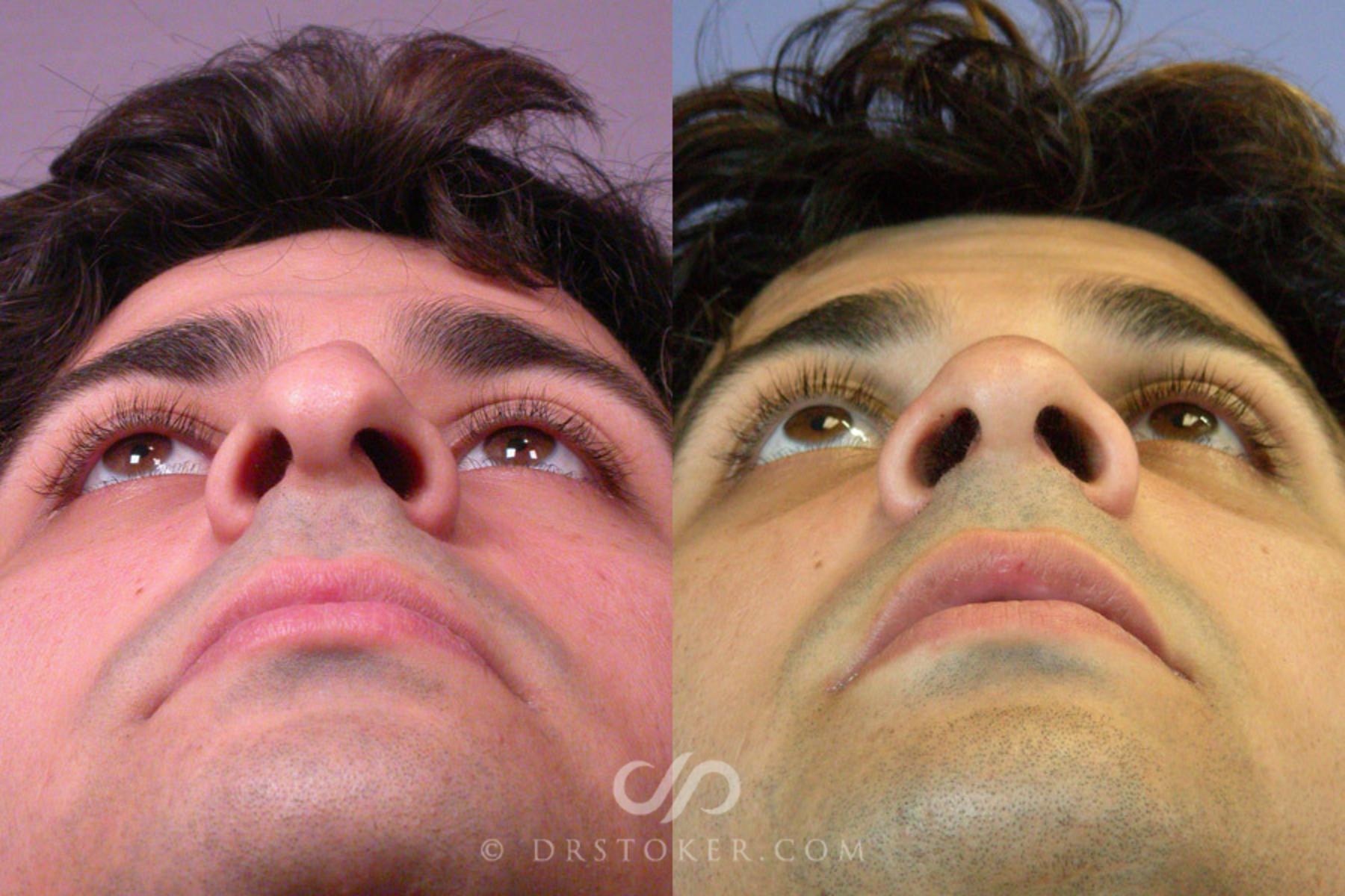 Before & After Rhinoplasty Case 304 View #5 View in Los Angeles, CA