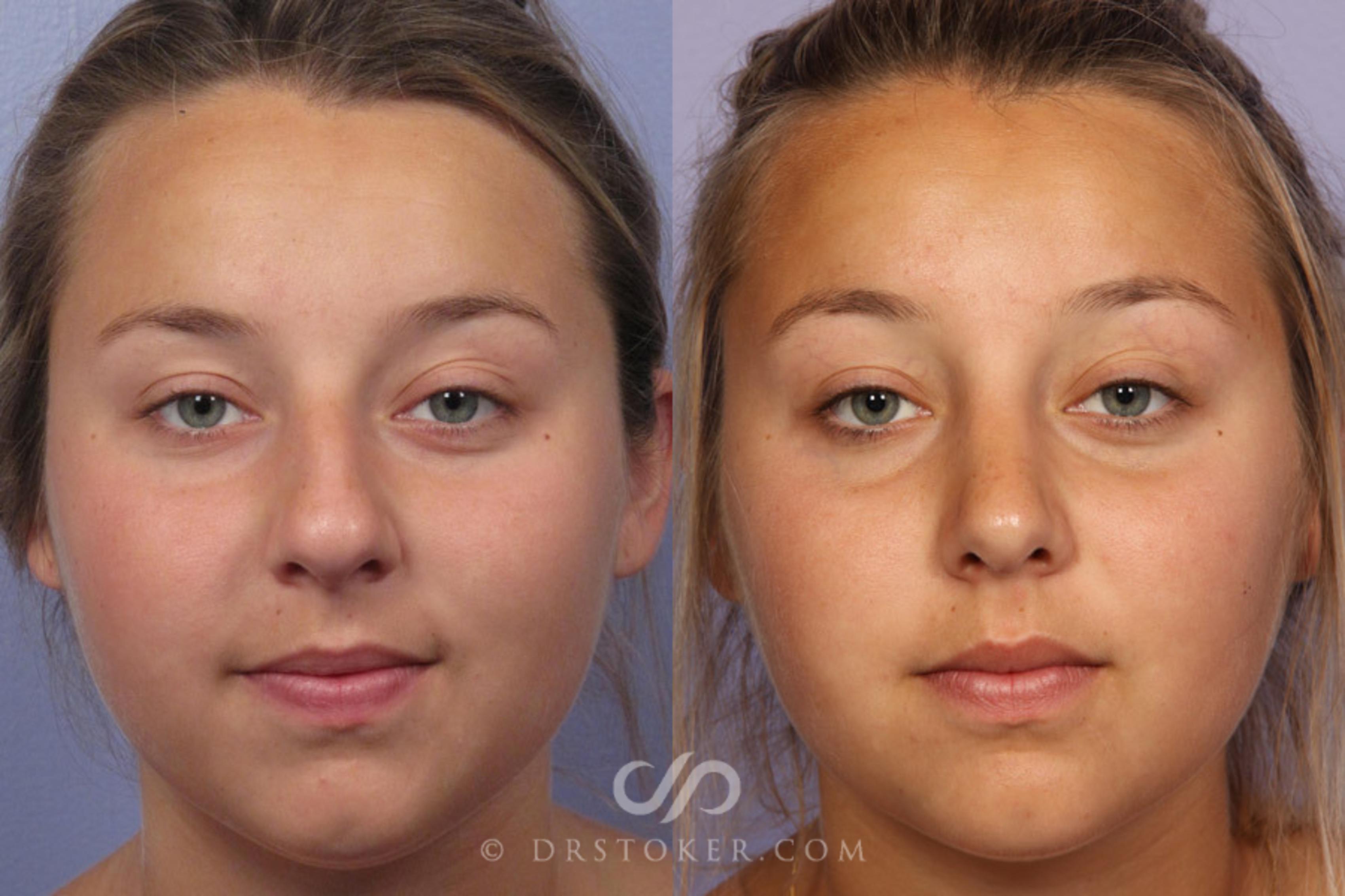 Before & After Rhinoplasty Case 305 View #1 View in Los Angeles, CA