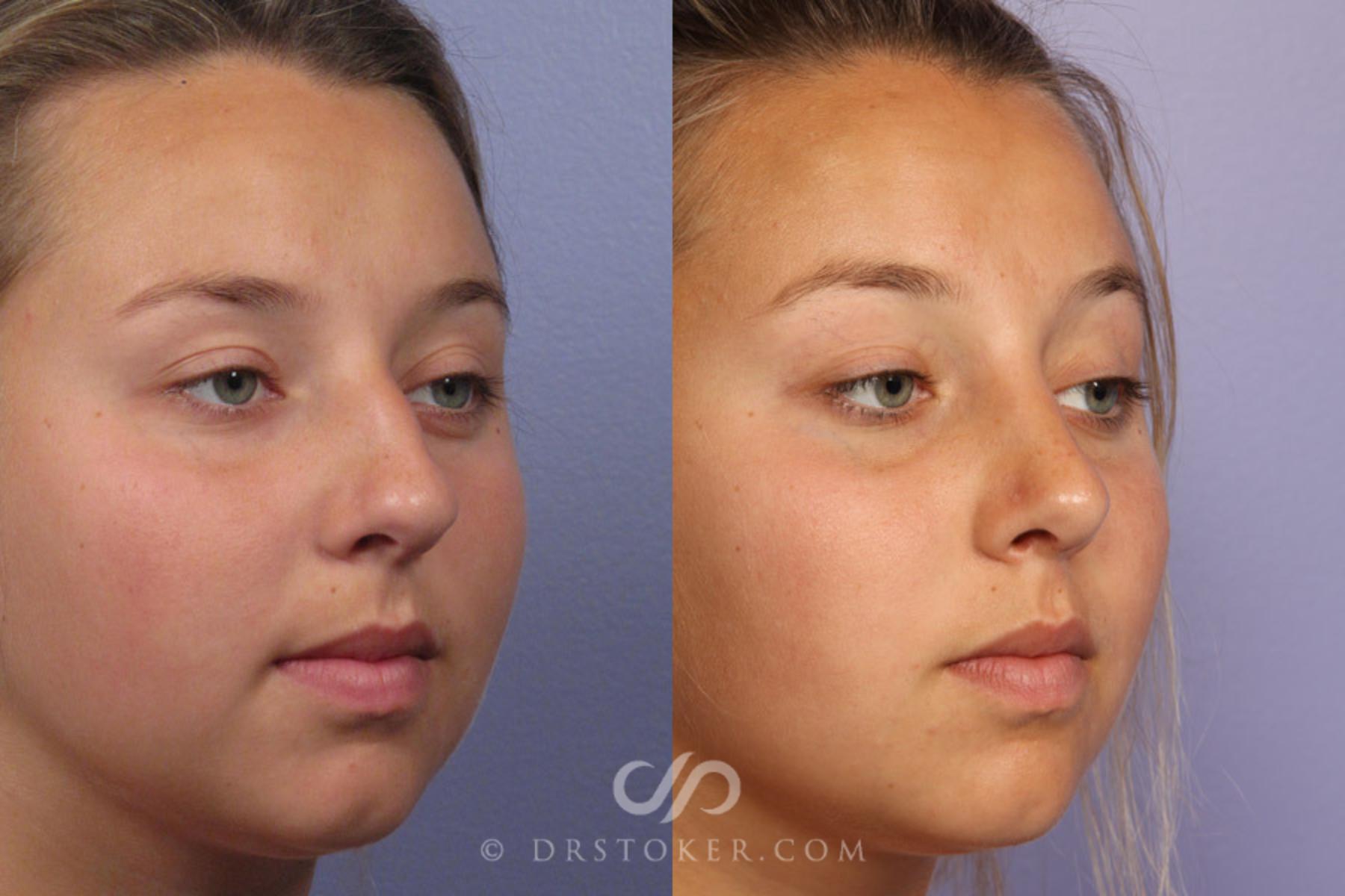 Before & After Rhinoplasty Case 305 View #2 View in Los Angeles, CA