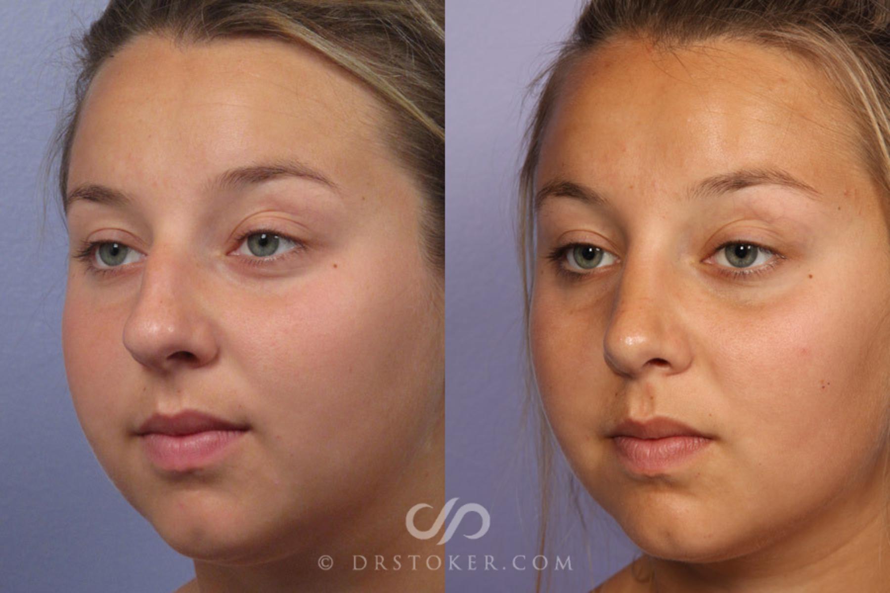 Before & After Rhinoplasty Case 305 View #3 View in Los Angeles, CA