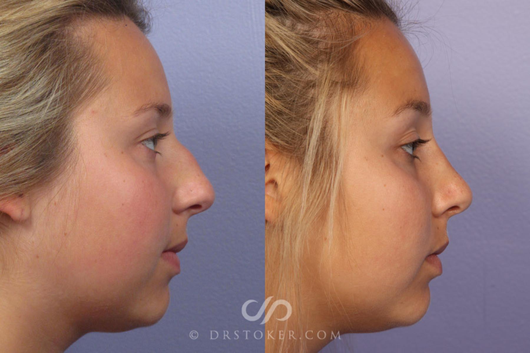 Before & After Rhinoplasty Case 305 View #4 View in Los Angeles, CA