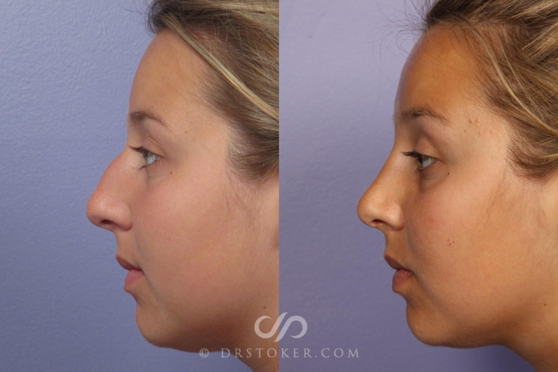 Before & After Rhinoplasty Case 305 View #5 View in Los Angeles, CA