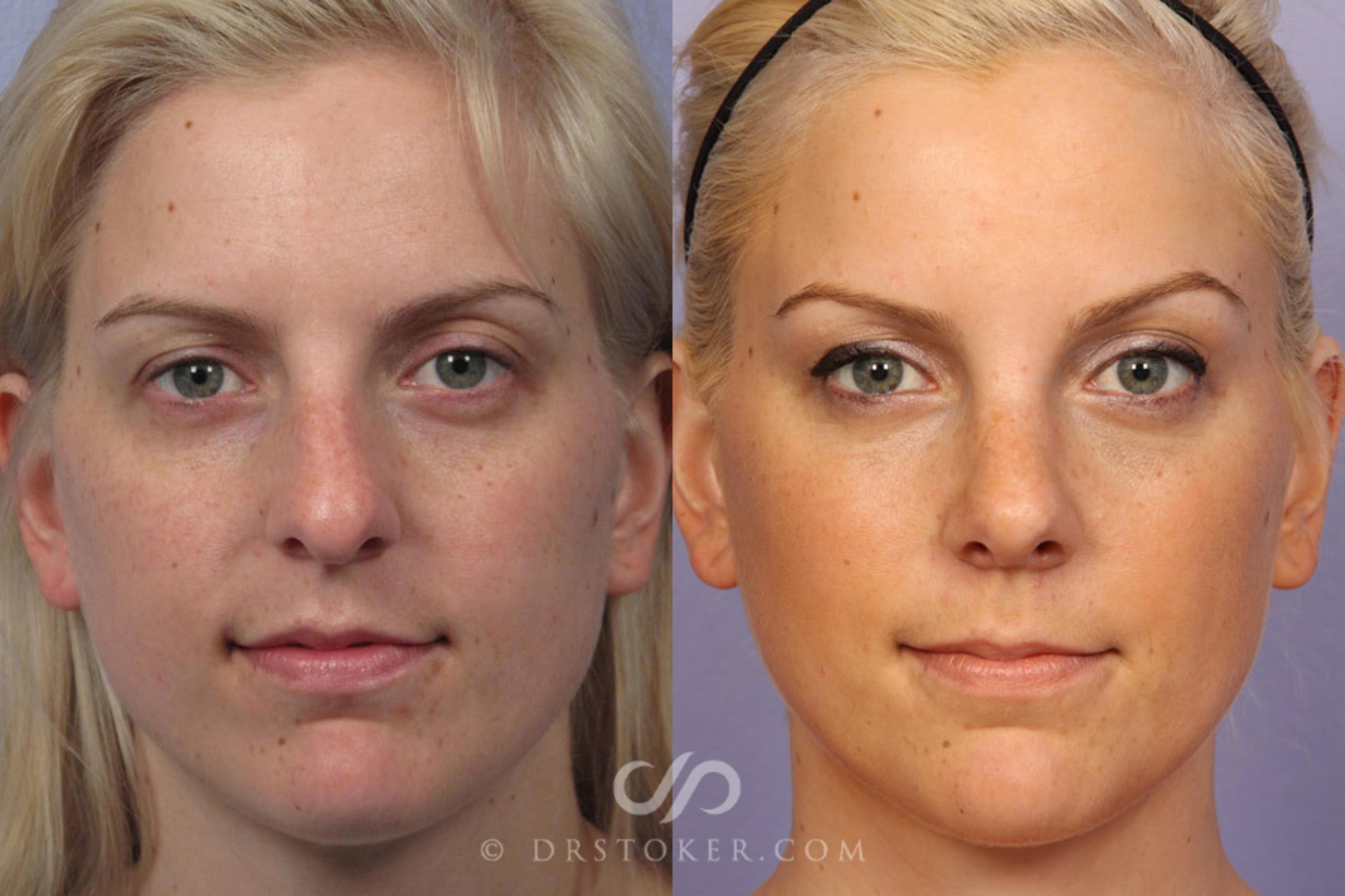 Before & After Rhinoplasty Case 306 View #1 View in Marina del Rey, CA