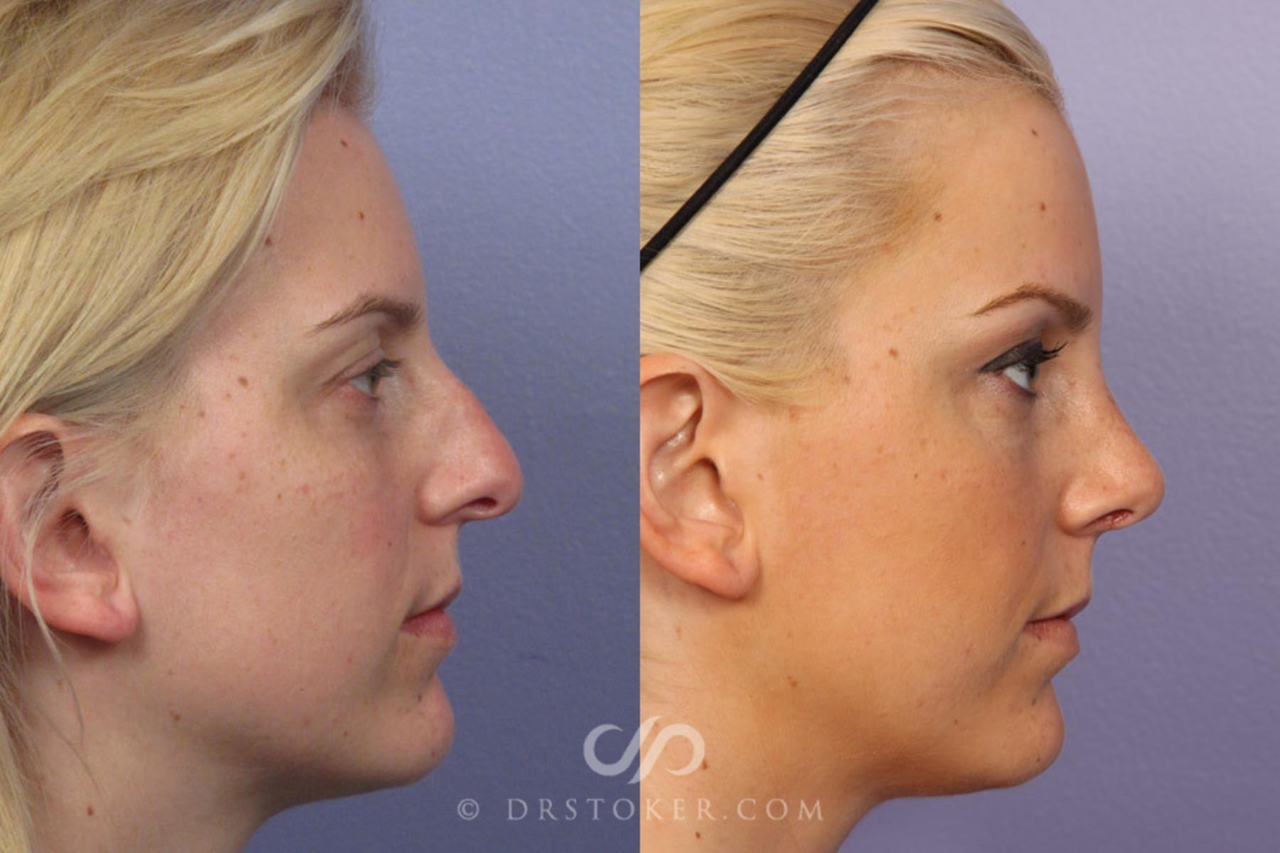 Before & After Rhinoplasty Case 306 View #3 View in Los Angeles, CA