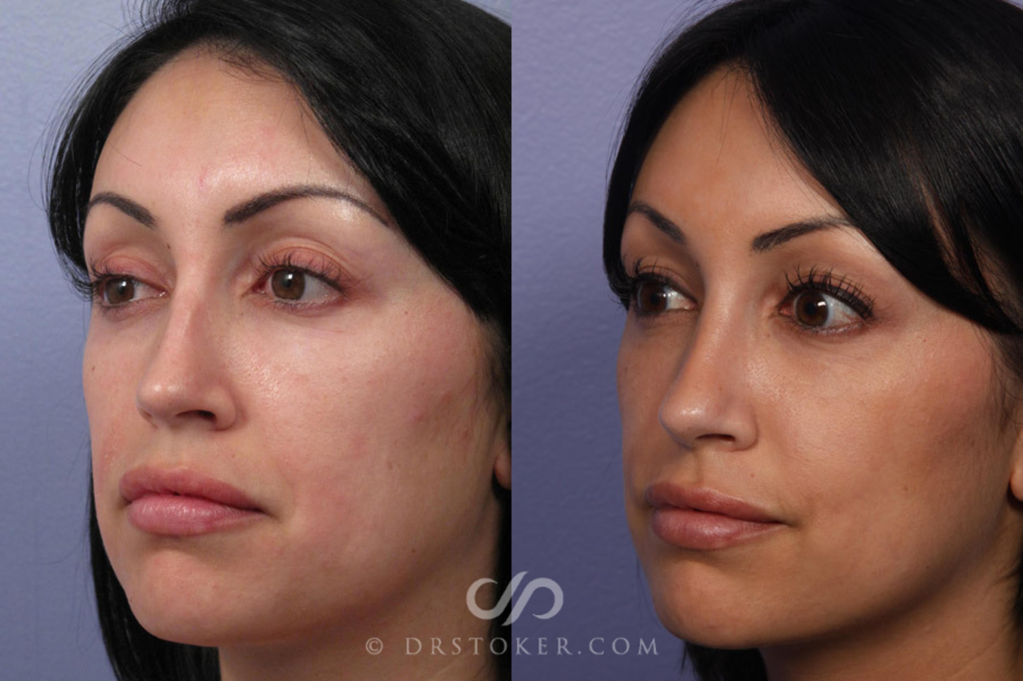 Before & After Rhinoplasty Case 307 View #3 View in Los Angeles, CA