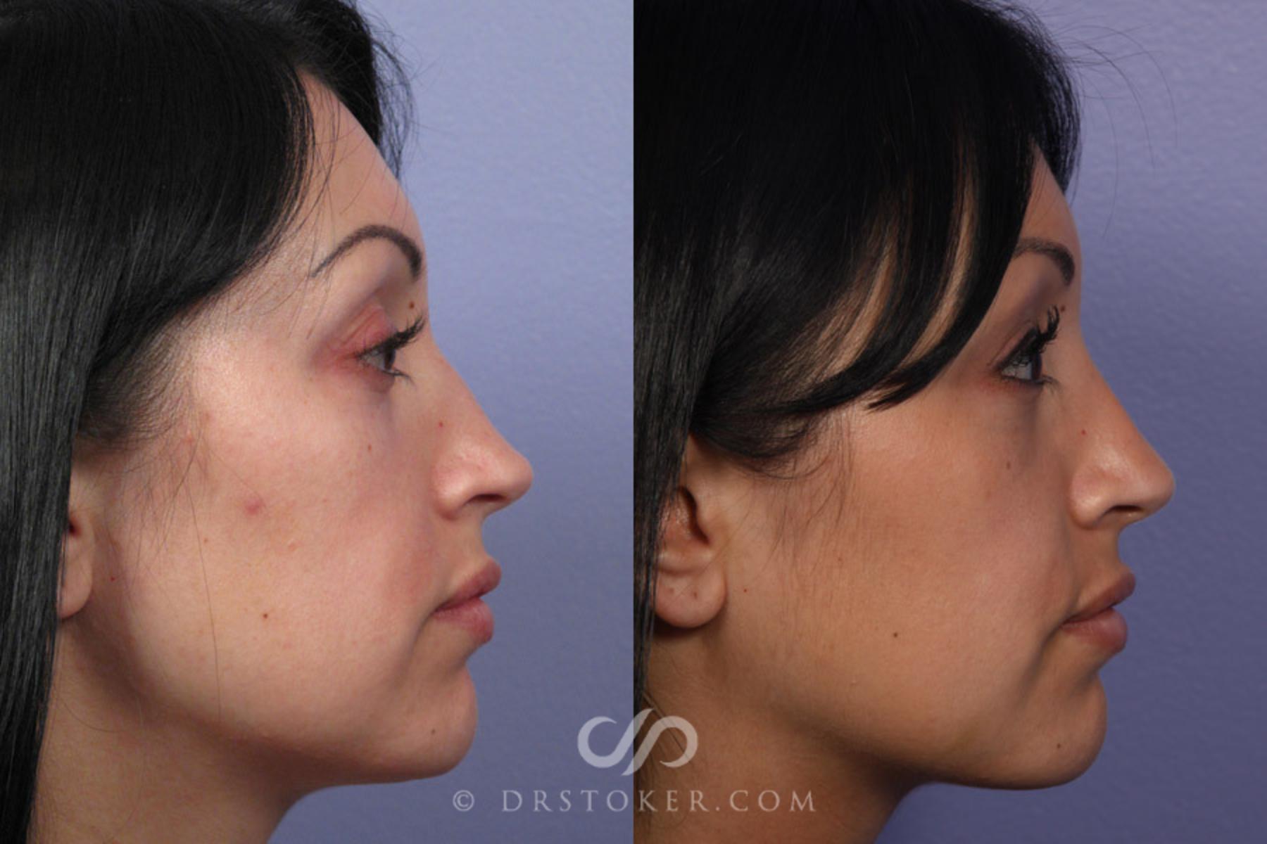 Before & After Rhinoplasty Case 307 View #4 View in Los Angeles, CA