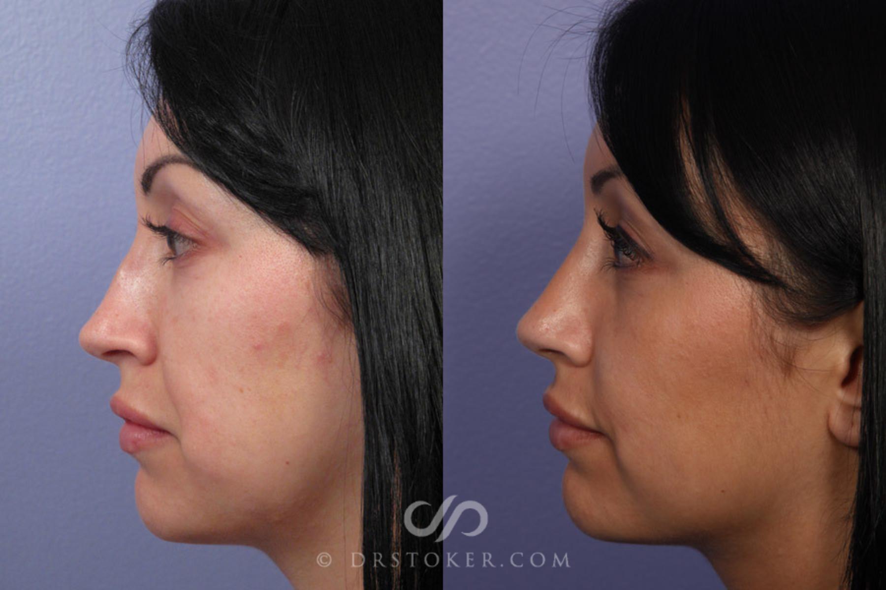 Before & After Rhinoplasty Case 307 View #5 View in Los Angeles, CA
