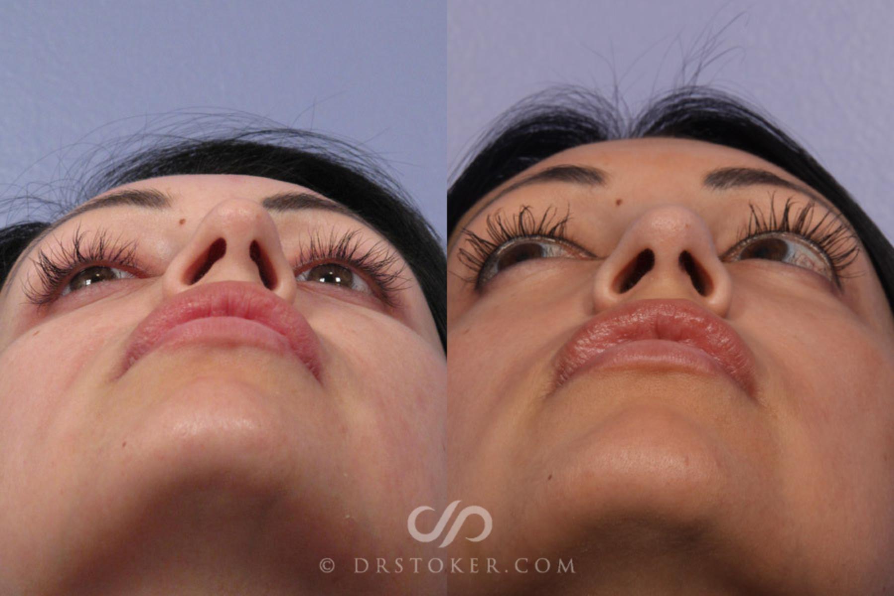 Before & After Rhinoplasty Case 307 View #6 View in Los Angeles, CA