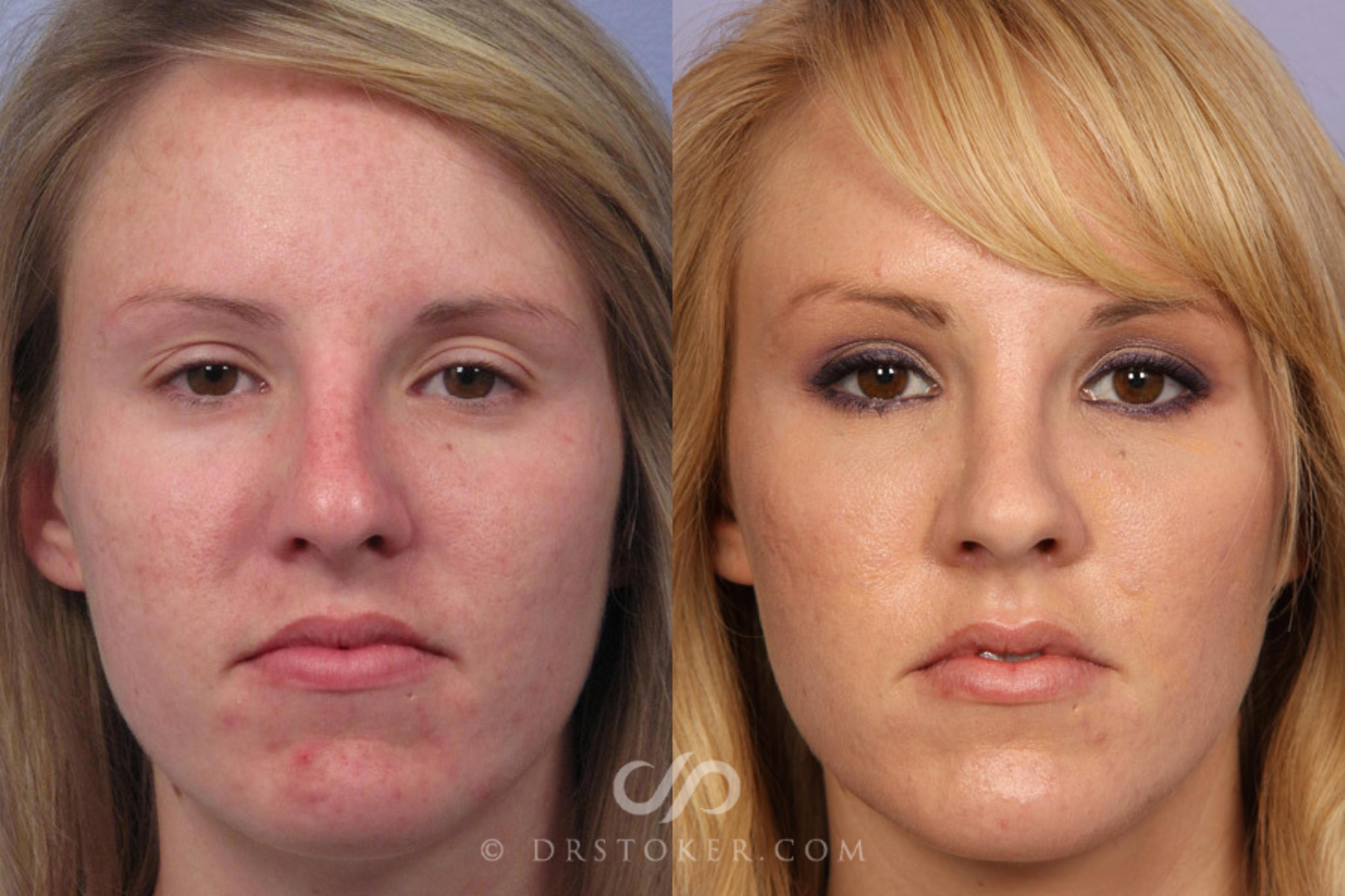Before & After Rhinoplasty Case 308 View #1 View in Los Angeles, CA