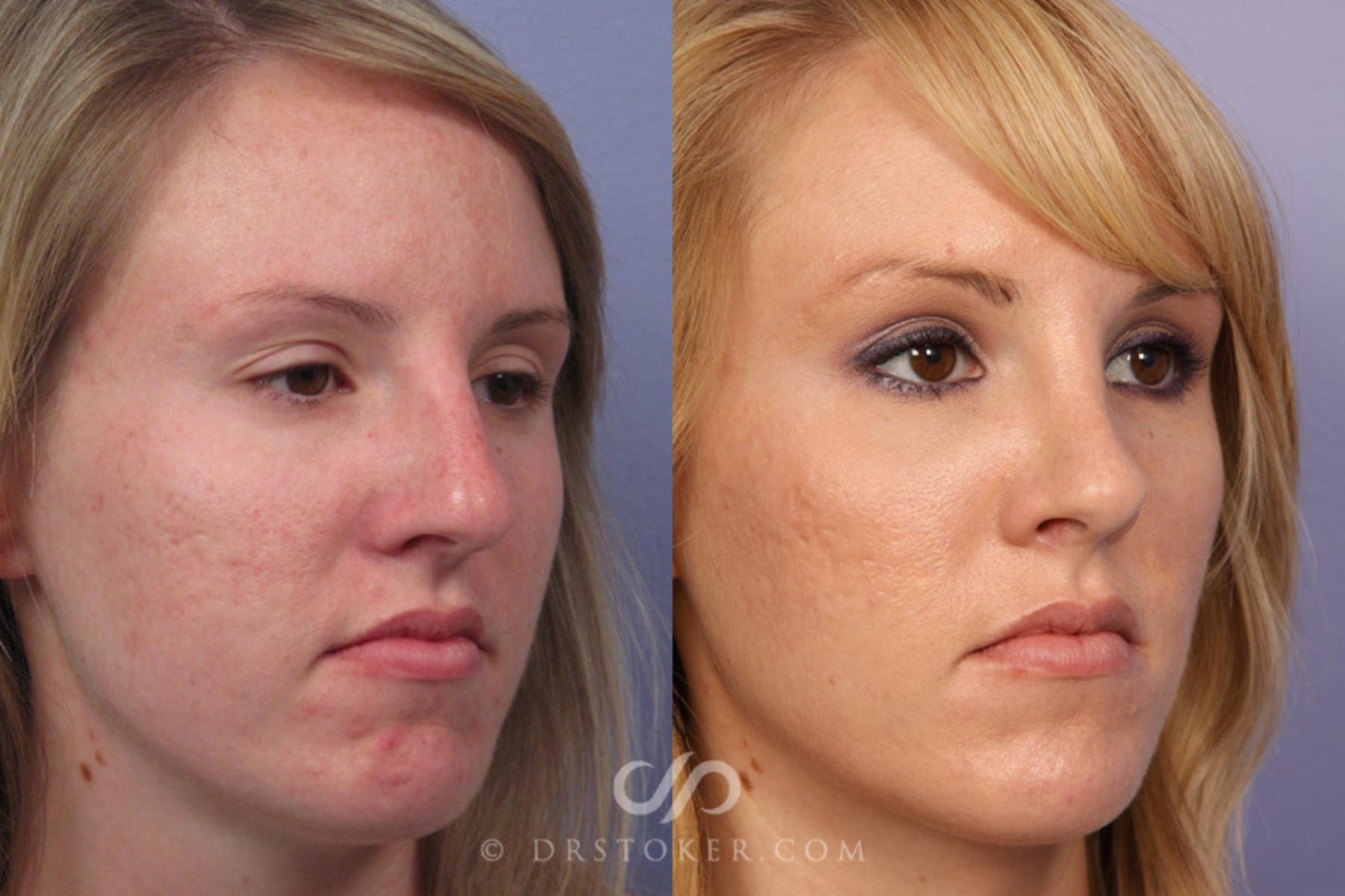 Before & After Rhinoplasty Case 308 View #2 View in Los Angeles, CA