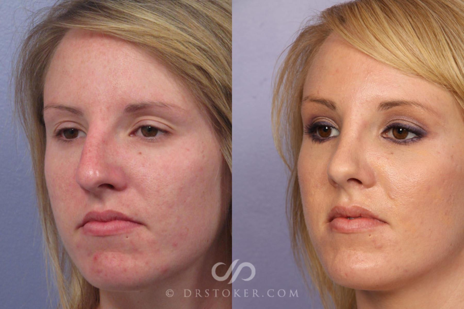 Before & After Rhinoplasty Case 308 View #3 View in Los Angeles, CA