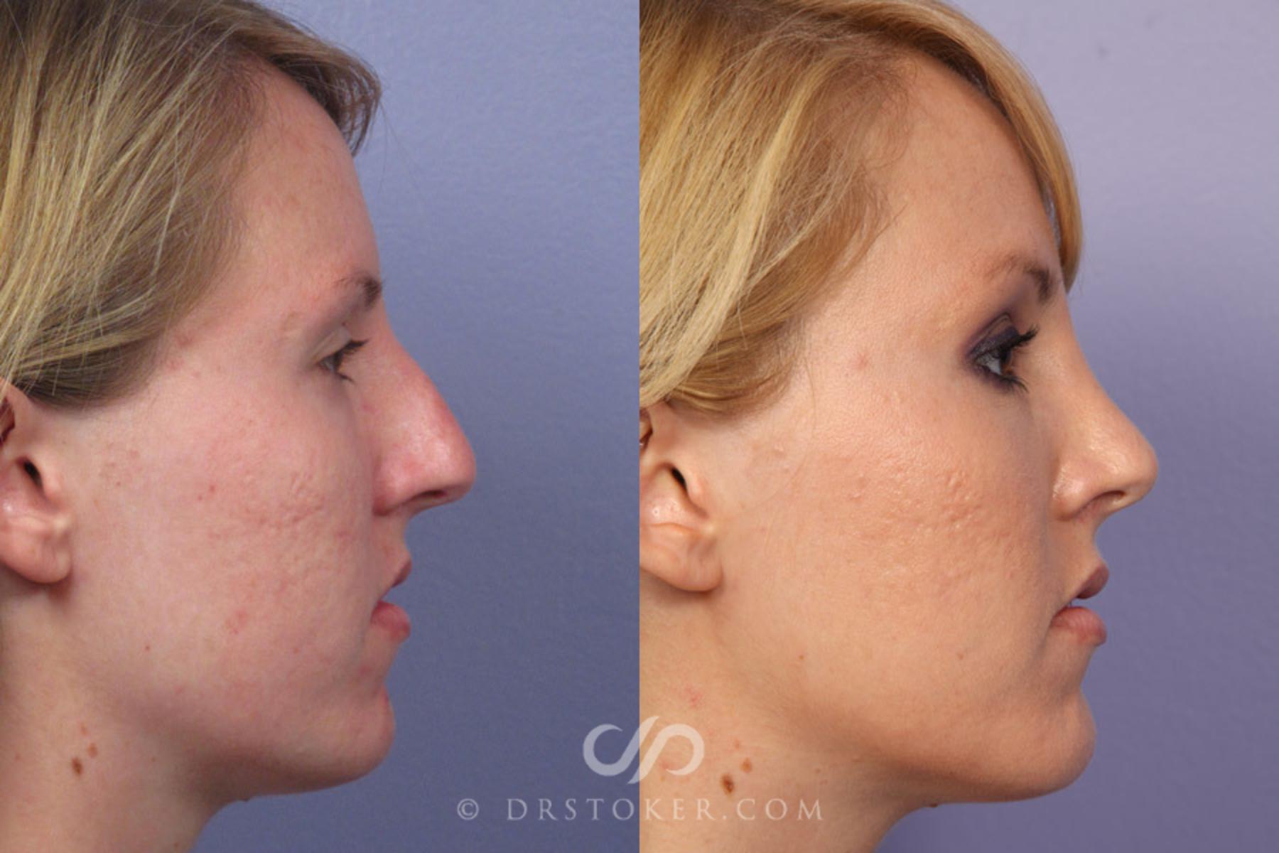 Before & After Rhinoplasty Case 308 View #4 View in Los Angeles, CA