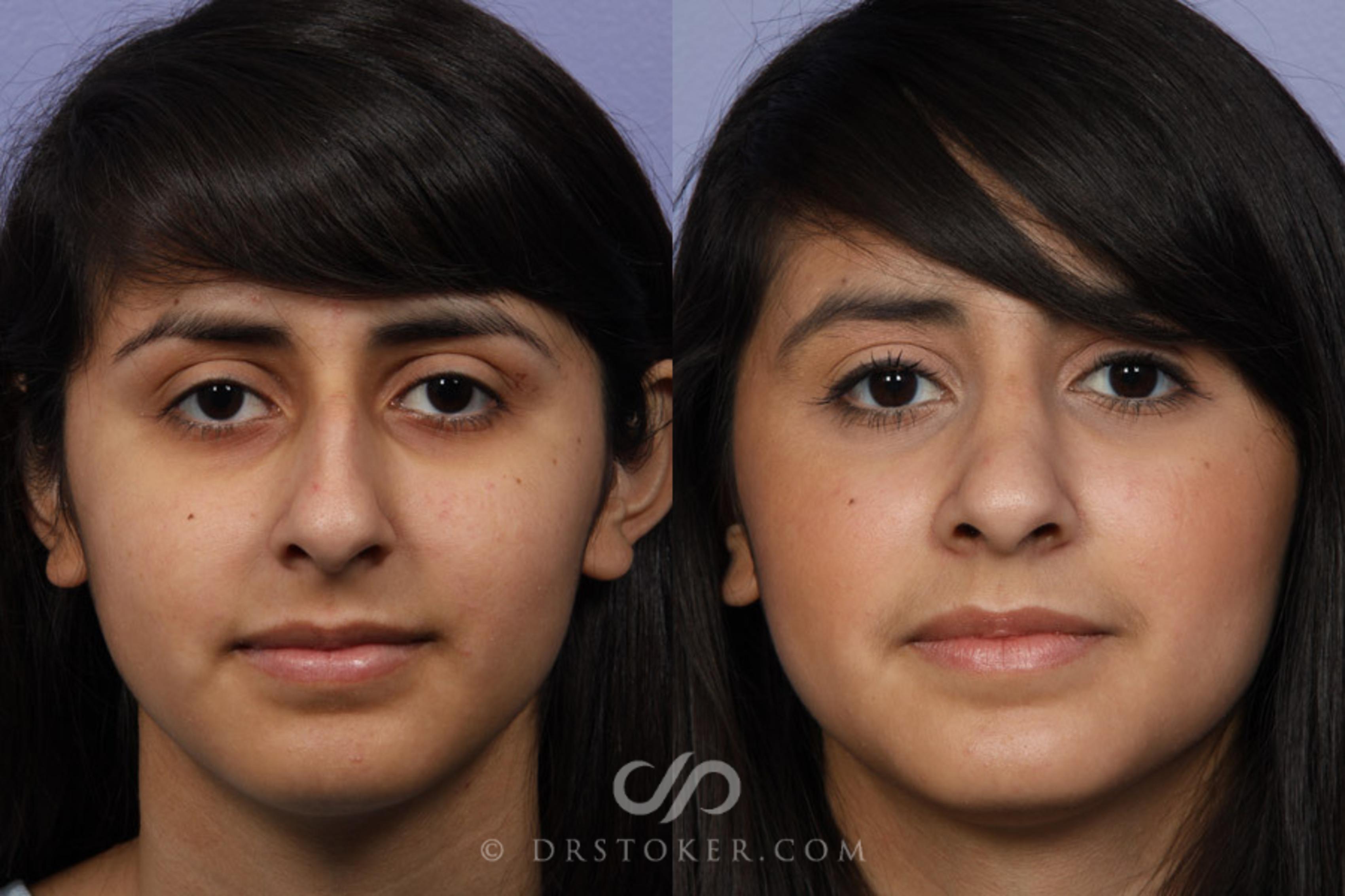 Before & After Rhinoplasty Case 324 View #1 View in Los Angeles, CA