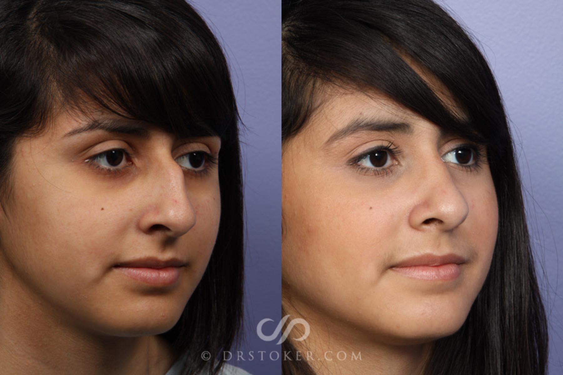 Before & After Rhinoplasty Case 324 View #2 View in Los Angeles, CA