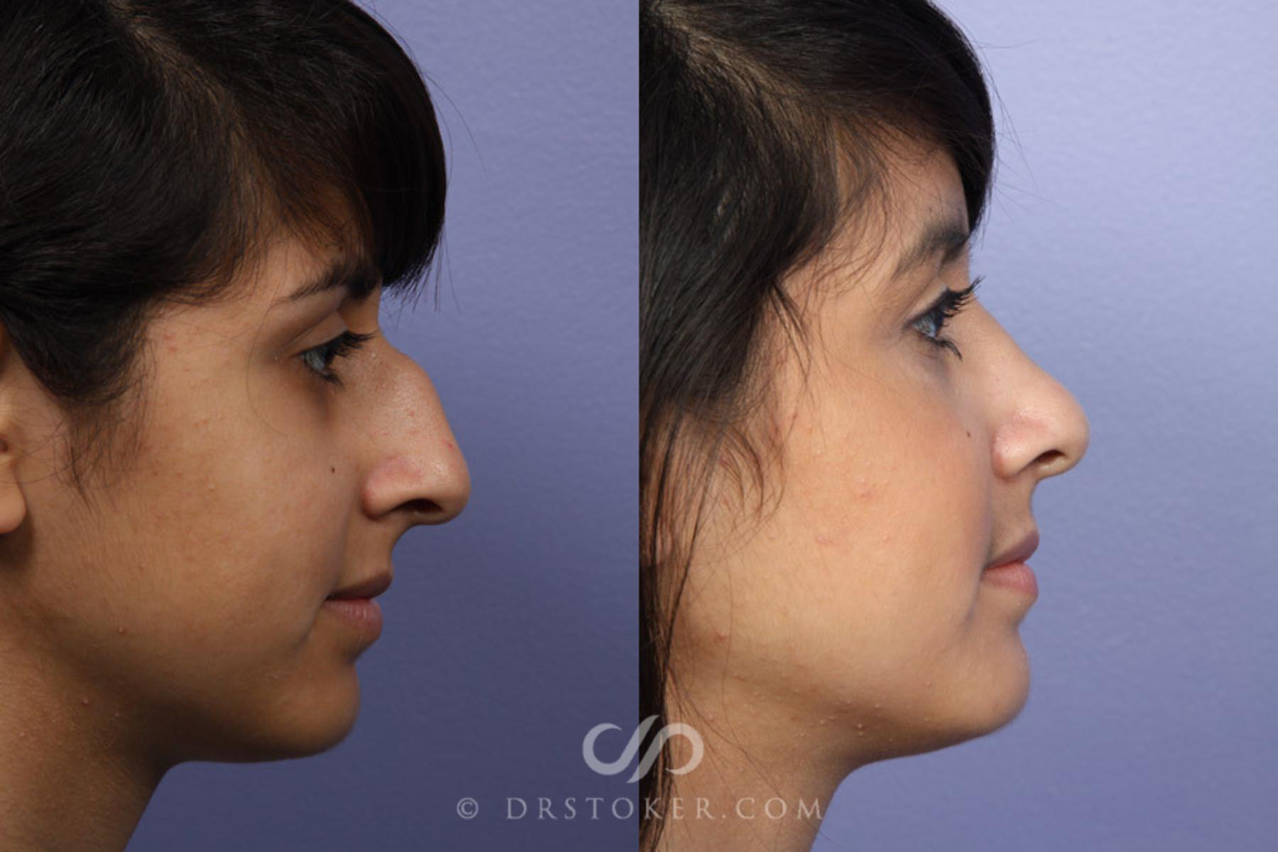 Before & After Rhinoplasty Case 324 View #3 View in Los Angeles, CA