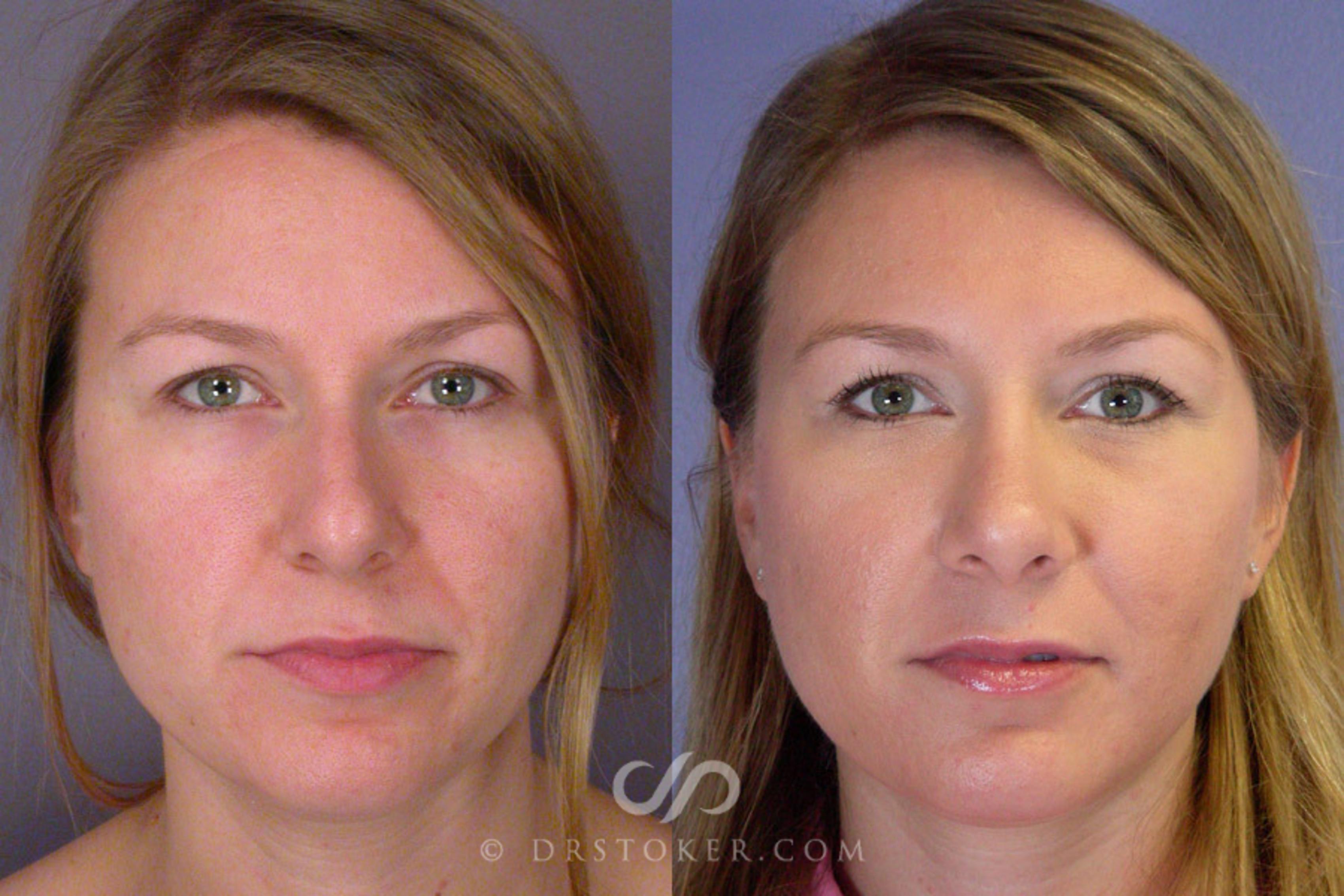 Before & After Rhinoplasty Case 325 View #1 View in Los Angeles, CA