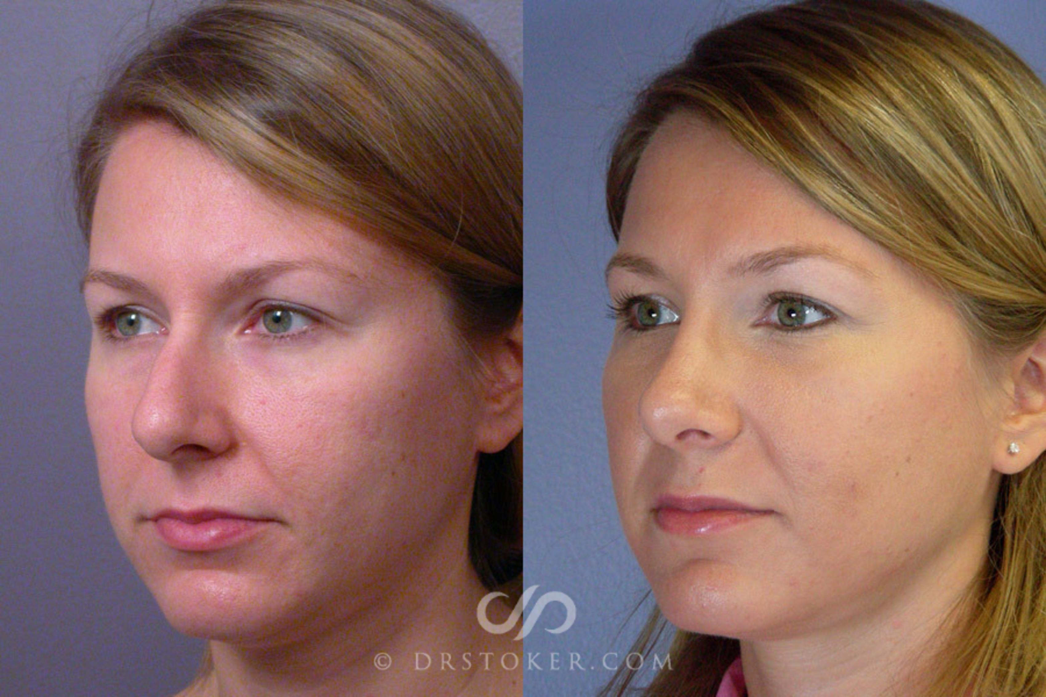 Before & After Rhinoplasty Case 325 View #2 View in Los Angeles, CA