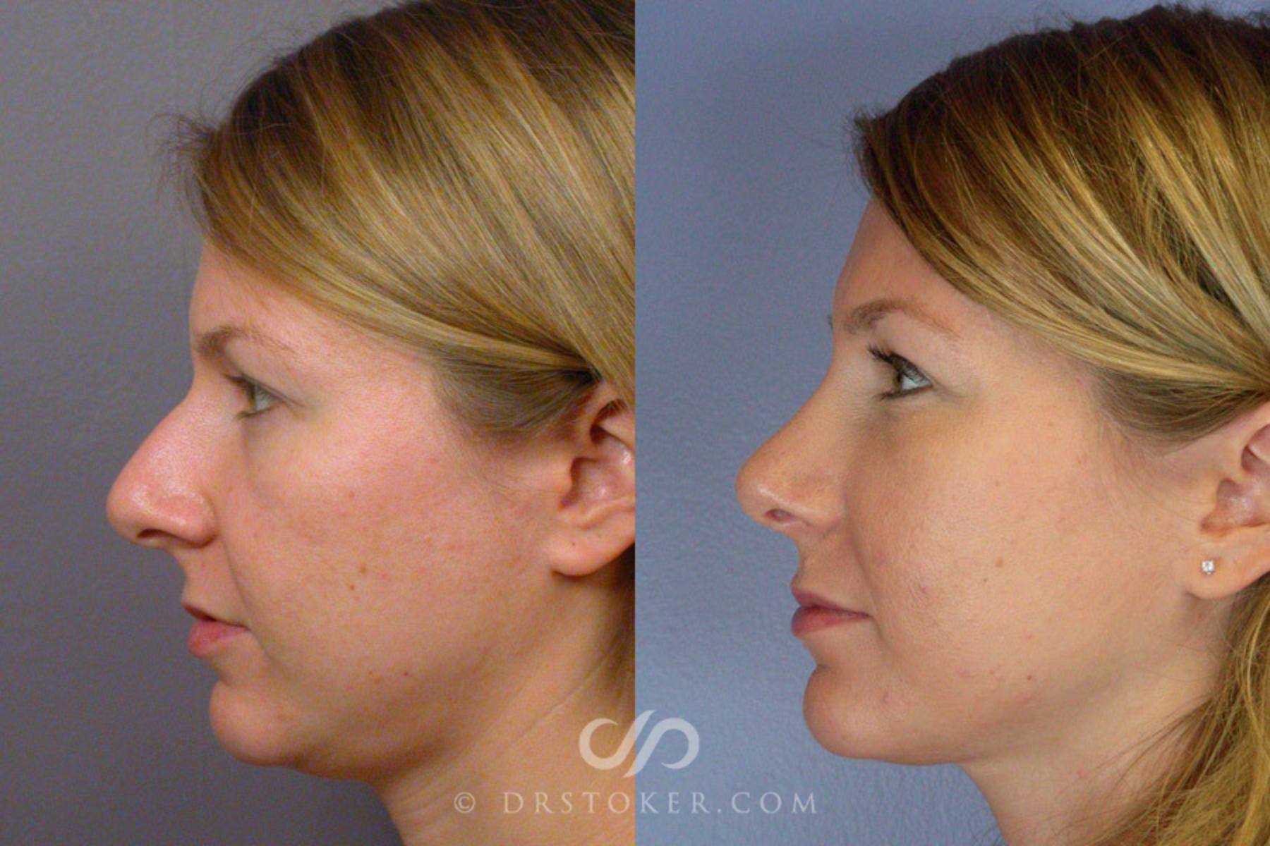 Before & After Rhinoplasty Case 325 View #3 View in Los Angeles, CA