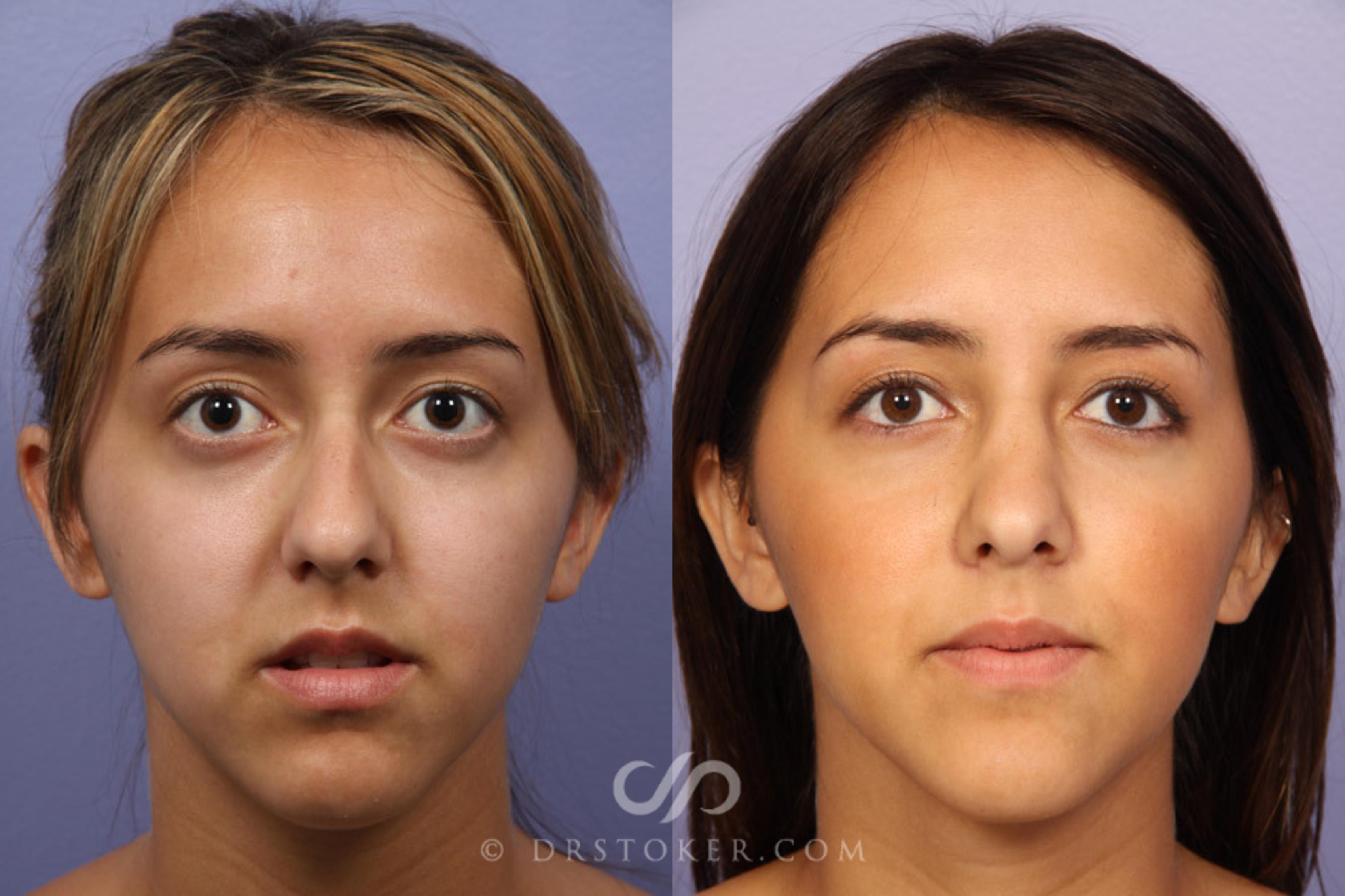 Before & After Rhinoplasty Case 326 View #1 View in Los Angeles, CA