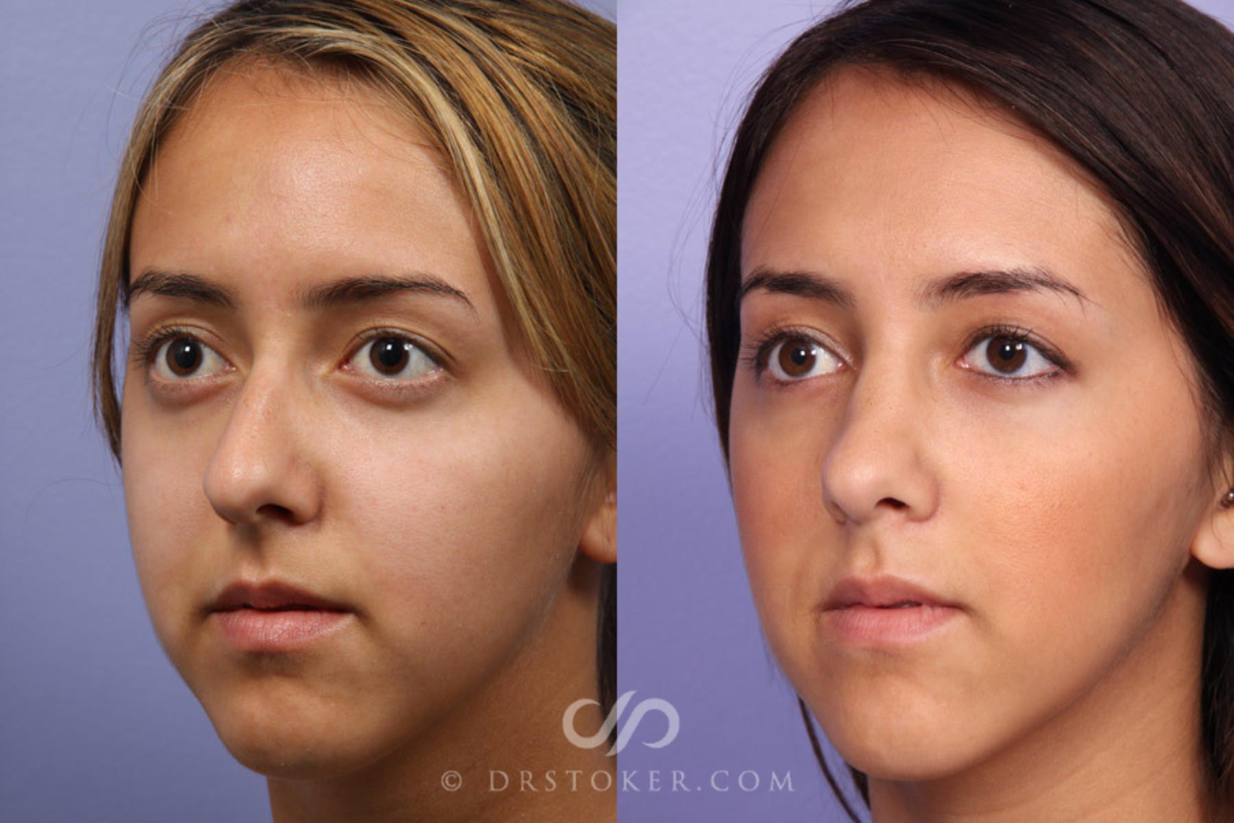 Before & After Rhinoplasty Case 326 View #2 View in Los Angeles, CA