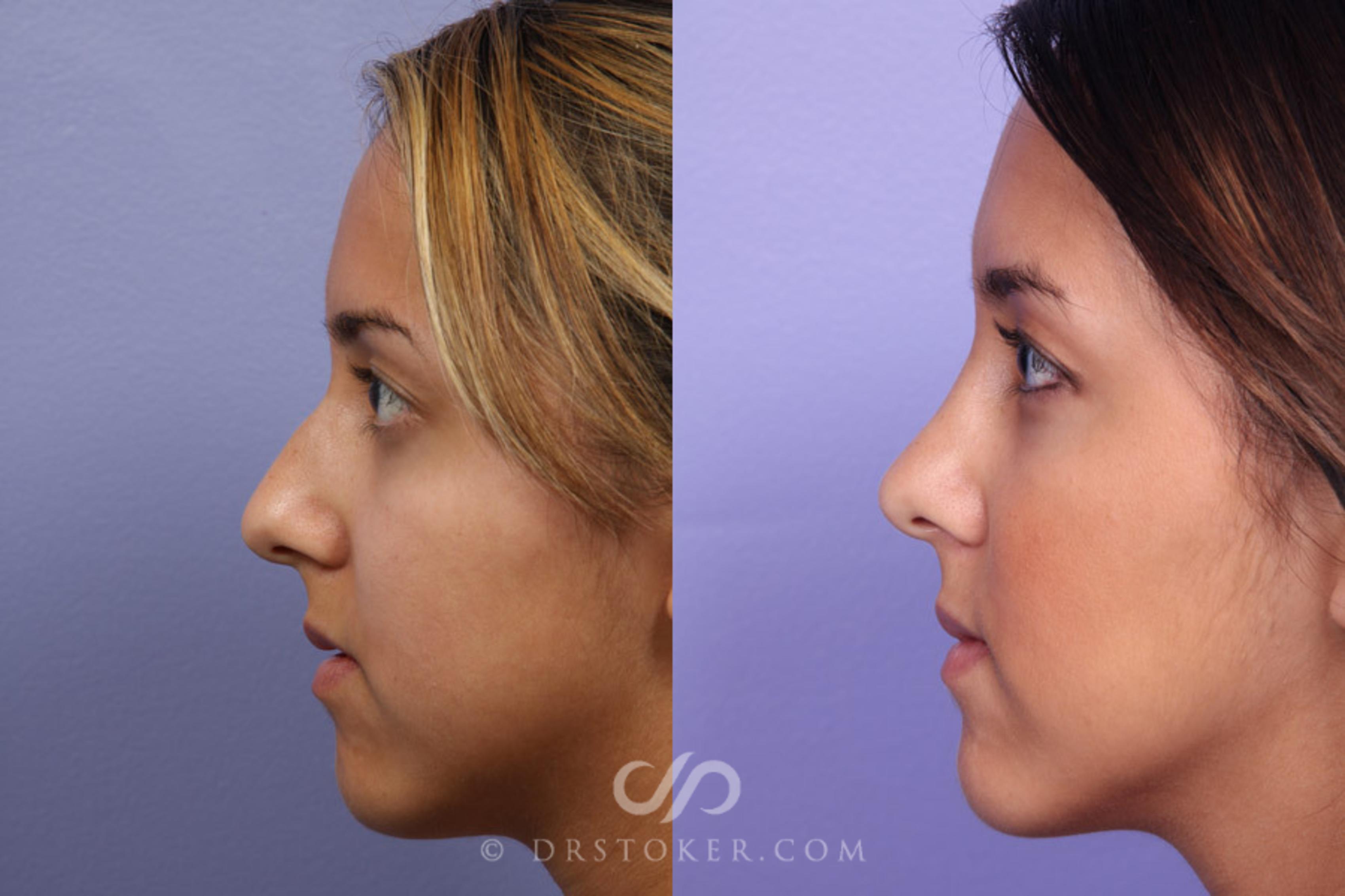 Before & After Rhinoplasty Case 326 View #3 View in Los Angeles, CA