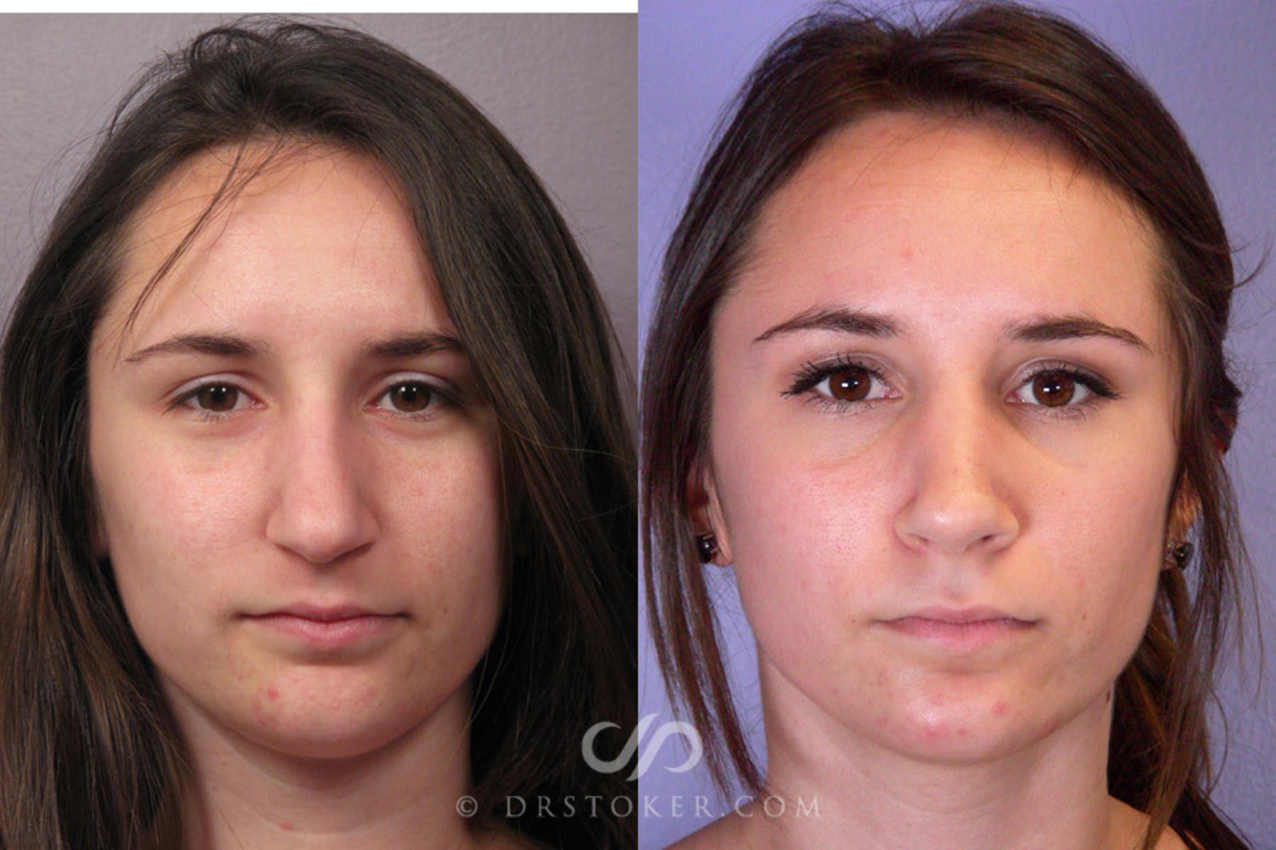 Before & After Rhinoplasty Case 333 View #1 View in Los Angeles, CA