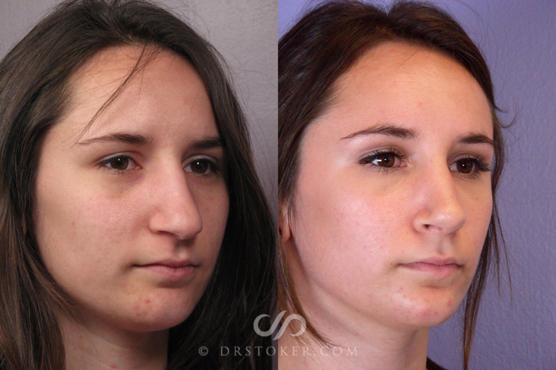 Before & After Rhinoplasty Case 333 View #2 View in Los Angeles, CA