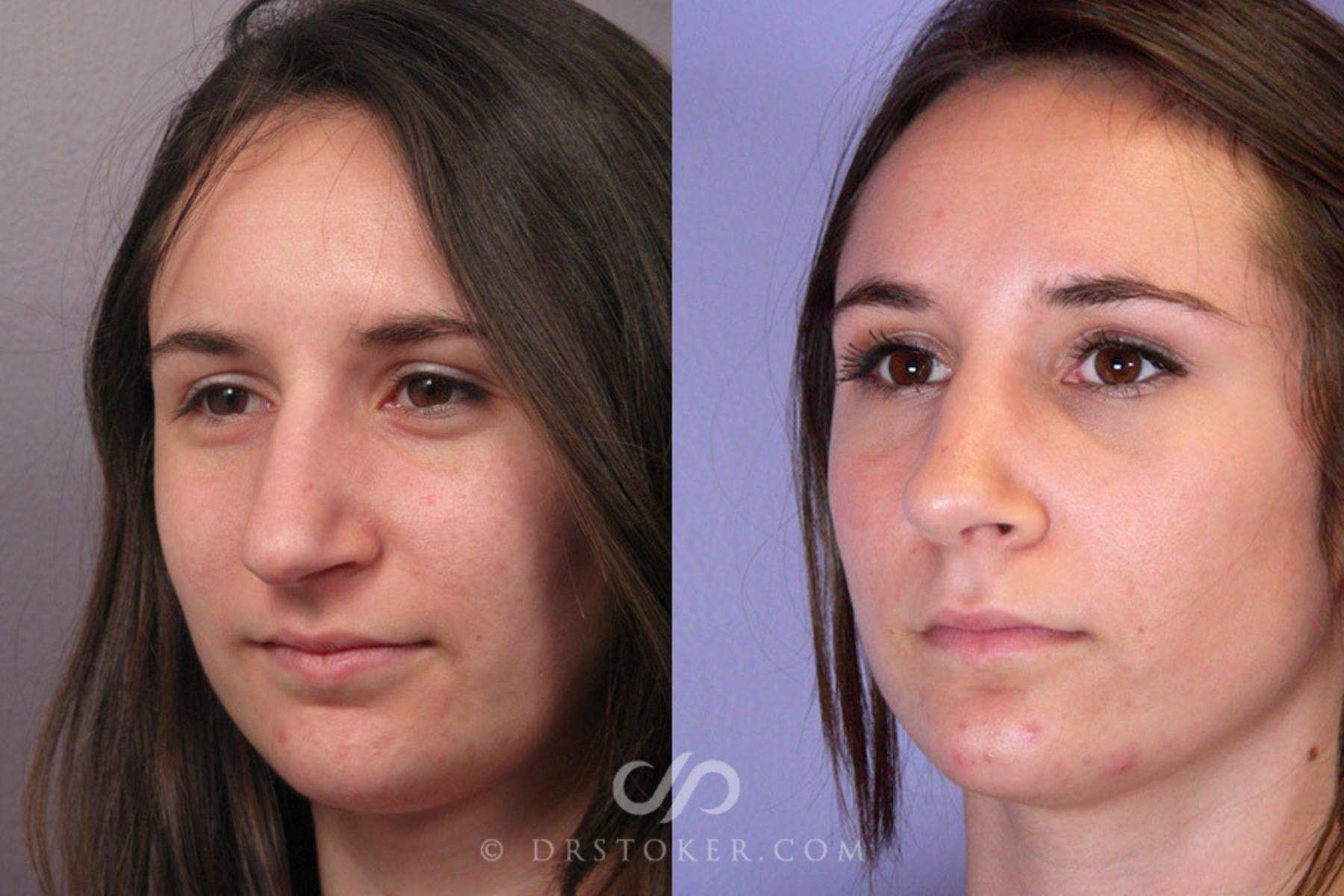 Before & After Rhinoplasty Case 333 View #3 View in Los Angeles, CA
