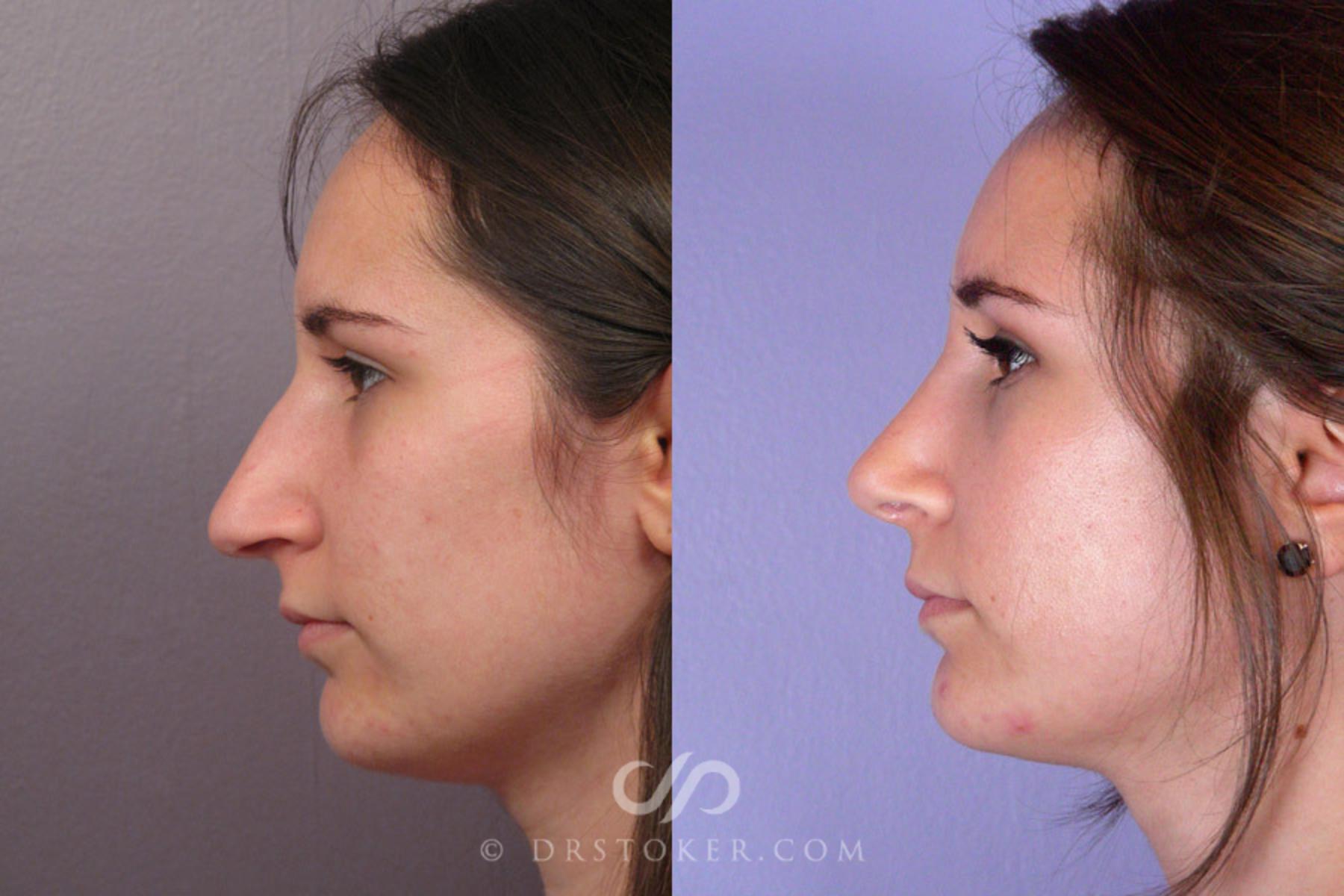 Before & After Rhinoplasty Case 333 View #5 View in Los Angeles, CA